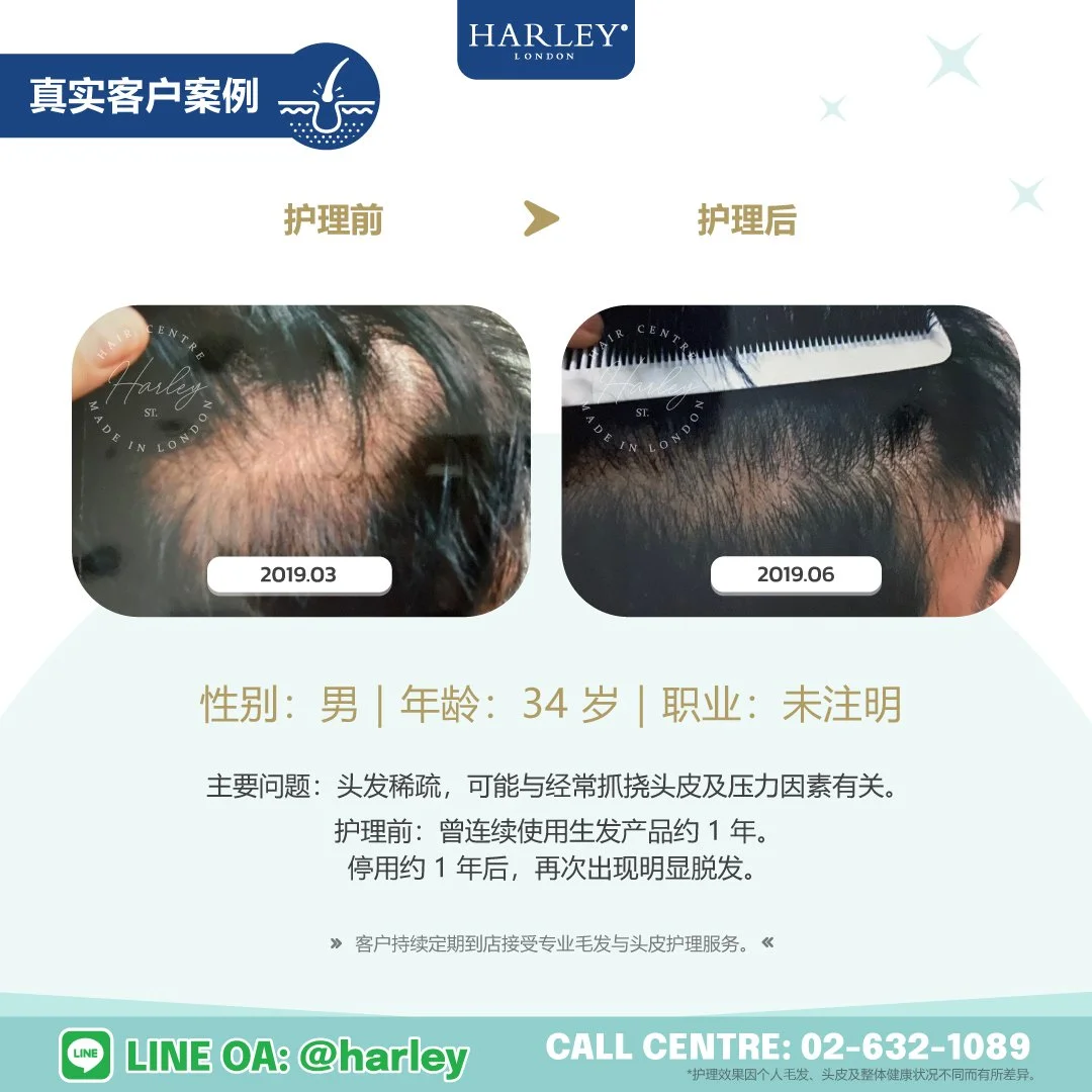 真实客户护理案例：34 岁男性，头发稀疏，可能与经常抓挠头皮及压力因素有关。护理前曾连续使用生发产品约 1 年，停用约 1 年后再次出现明显脱发。展示 Harley St. Hair Centre 专业毛发与头皮护理前后的变化。