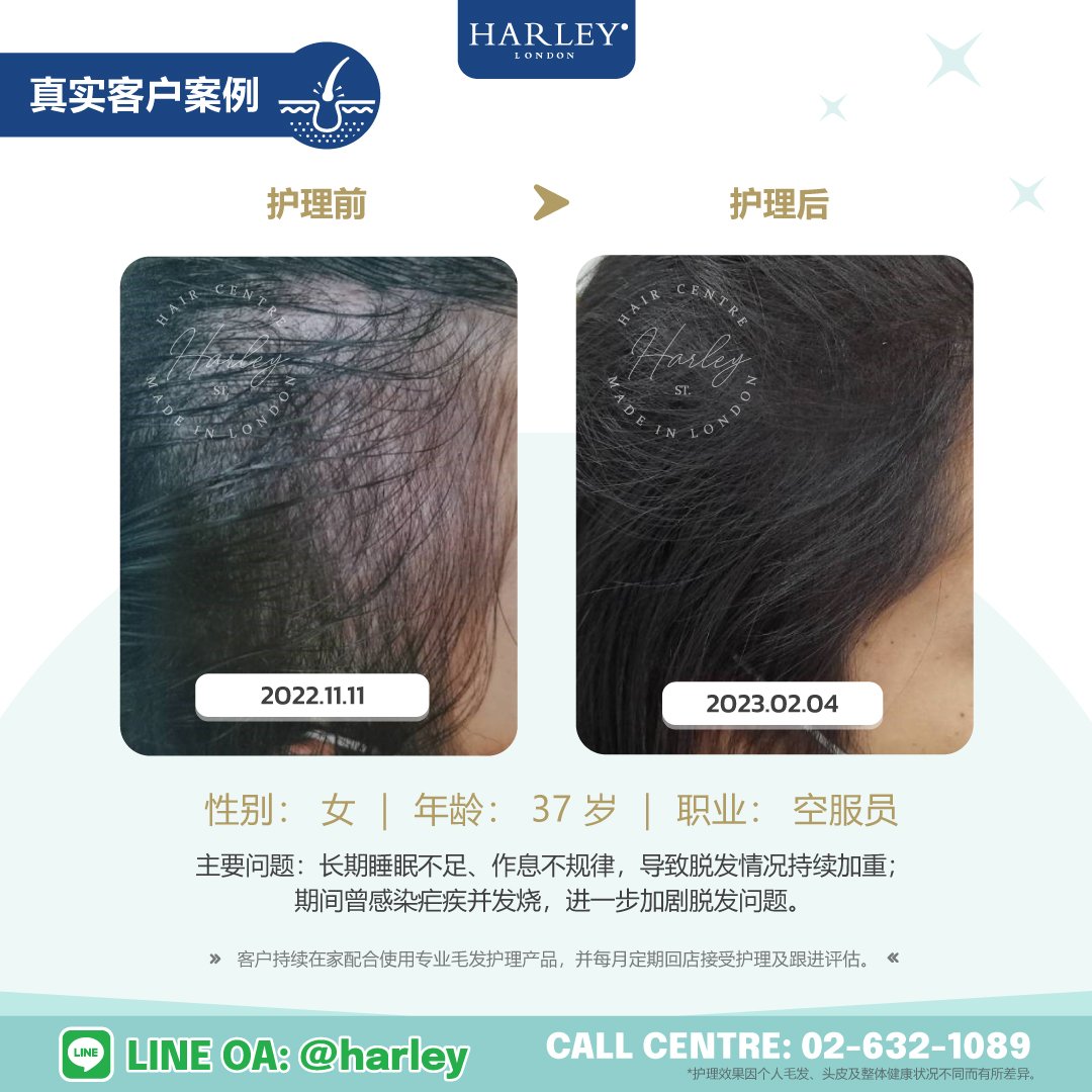 Harley St. Hair Centre Ladprao 真实客户护理案例，37 岁女性空服员因长期睡眠不足及作息不规律导致脱发，接受专业毛发与头皮护理后的前后对比。