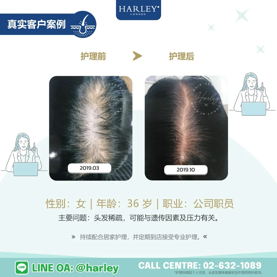 Harley St. Hair Centre Rangsit 真实客户护理案例，36 岁女性因头发稀疏，可能与遗传因素及压力有关，接受专业毛发与头皮护理后的护理前后对比。