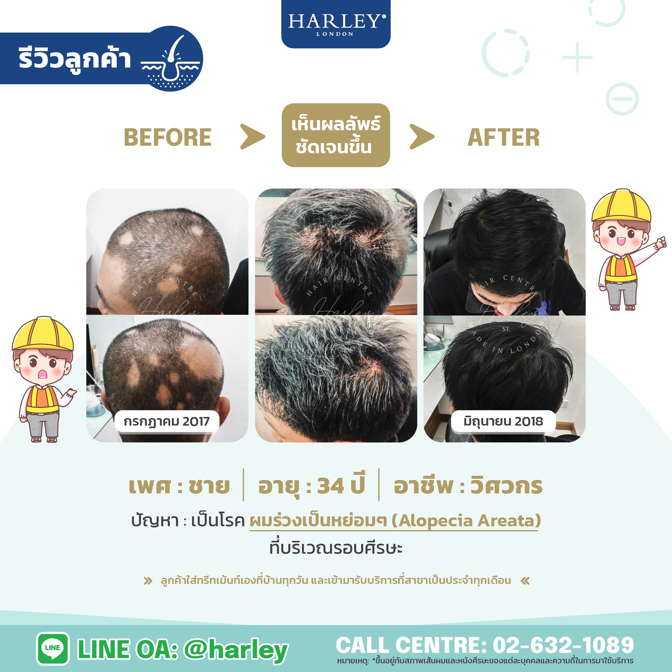 รีวิวเพศชายอายุ 34 ปีมีอาการผมร่วงเป็นหย่อมๆ แสดงให้เห็นว่าก่อนเข้ามารักษาผมร่วงเกือบทั้งศีรษะ ปัจจุบันผมขึ้นหนาหลังเข้ารับบริการลดผมร่วงกับ ฮาร์ลีย์