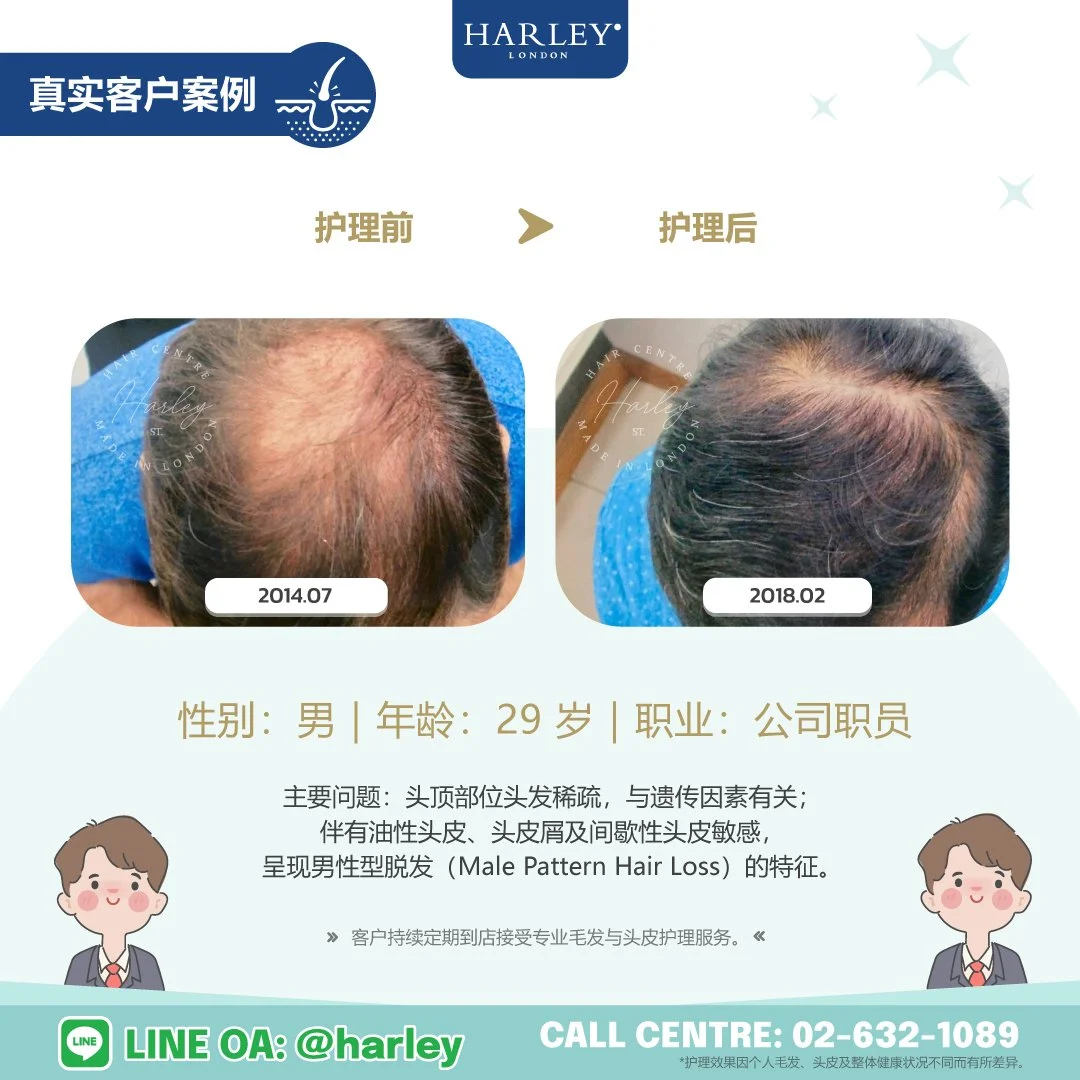 真实男性客户护理案例，记录头顶部位头发稀疏的护理前后变化。客户头发稀疏与遗传因素有关，并呈现男性型脱发（Male Pattern Hair Loss）的特征，同时伴有油性头皮、头皮屑及间歇性头皮敏感。客户持续定期到店接受专业毛发与头皮护理服务。护理效果因个人毛发、头皮及整体健康状况不同而有所差异。