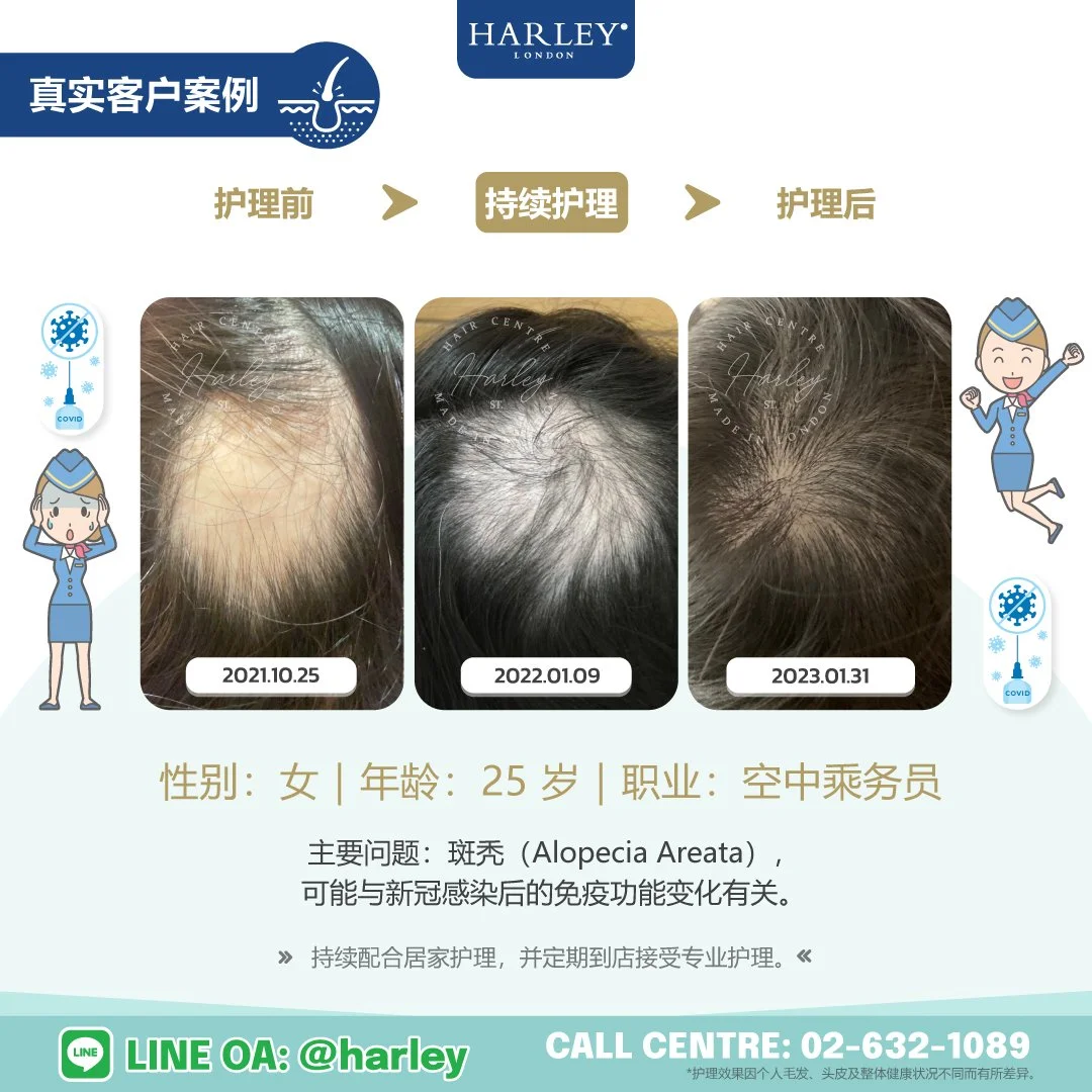 真实女性客户护理案例，记录斑秃（Alopecia Areata）护理前、持续护理及护理后的变化。客户持续接受专业毛发与头皮护理，并配合居家护理建议，头发逐步恢复生长。个别案例中，斑秃可能与新冠感染后的免疫功能变化有关。护理效果因个人毛发、头皮及整体健康状况不同而有所差异。