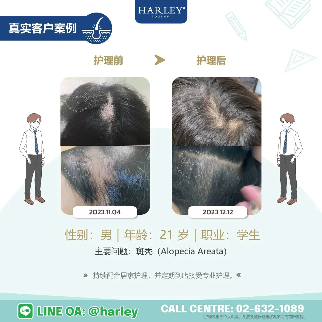 真实男性客户案例，展示斑秃（Alopecia Areata）护理前后对比。经过专业毛发与头皮护理后，头发逐步恢复生长。护理效果因个人毛发、头皮及整体健康状况不同而有所差异。