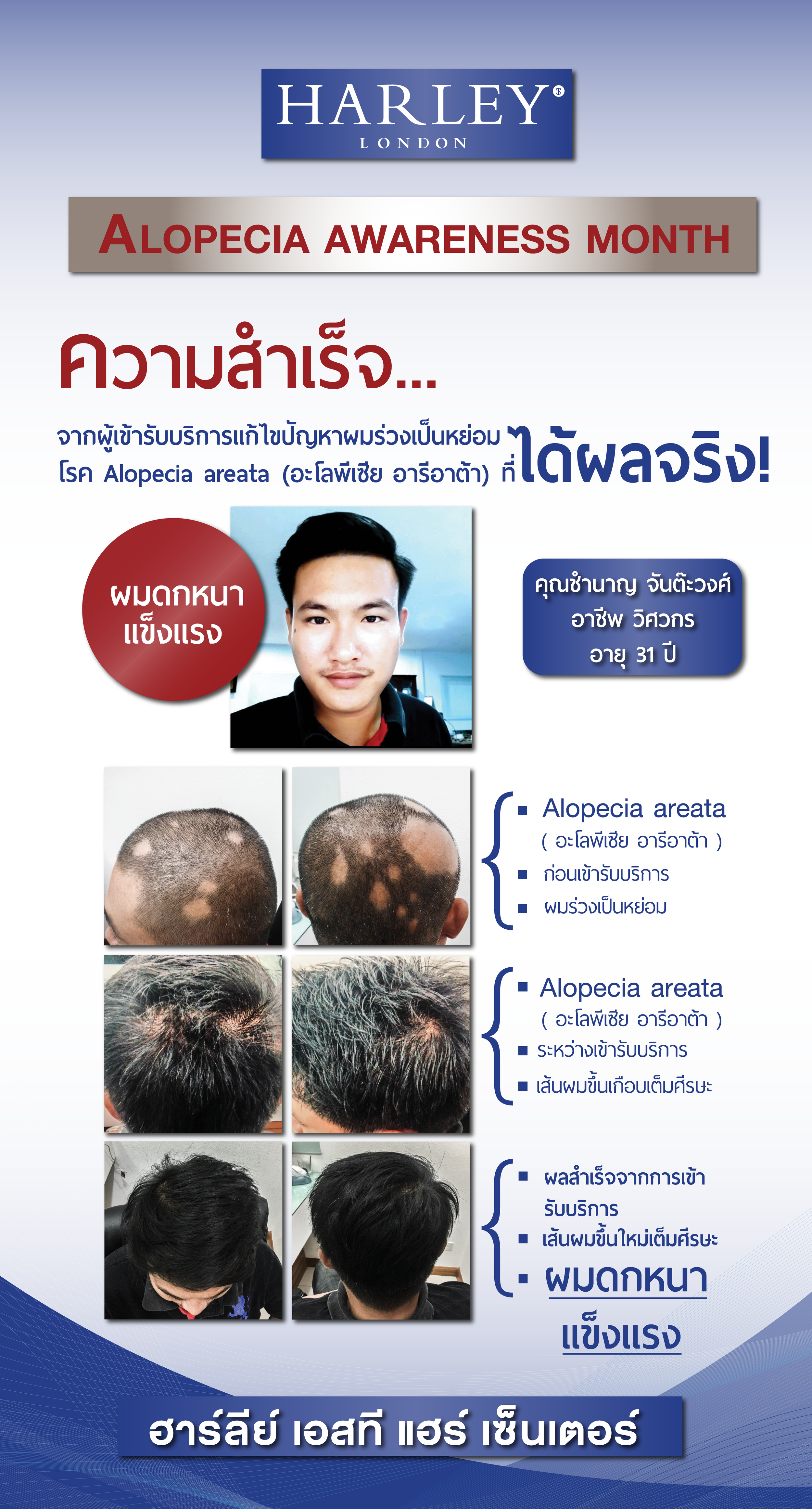 ภาพเปรียบเทียบผลลัพธ์ก่อนและหลังการรักษาโรคผมร่วงเป็นหย่อม (Alopecia Areata) ของลูกค้าจริง