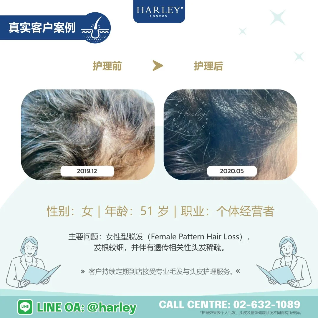 真实客户护理案例：51 岁女性，女性型脱发（Female Pattern Hair Loss）及遗传相关性头发稀疏。经过 Harley St. Hair Centre 专业毛发与头皮护理后，对比护理前后头发状态变化。