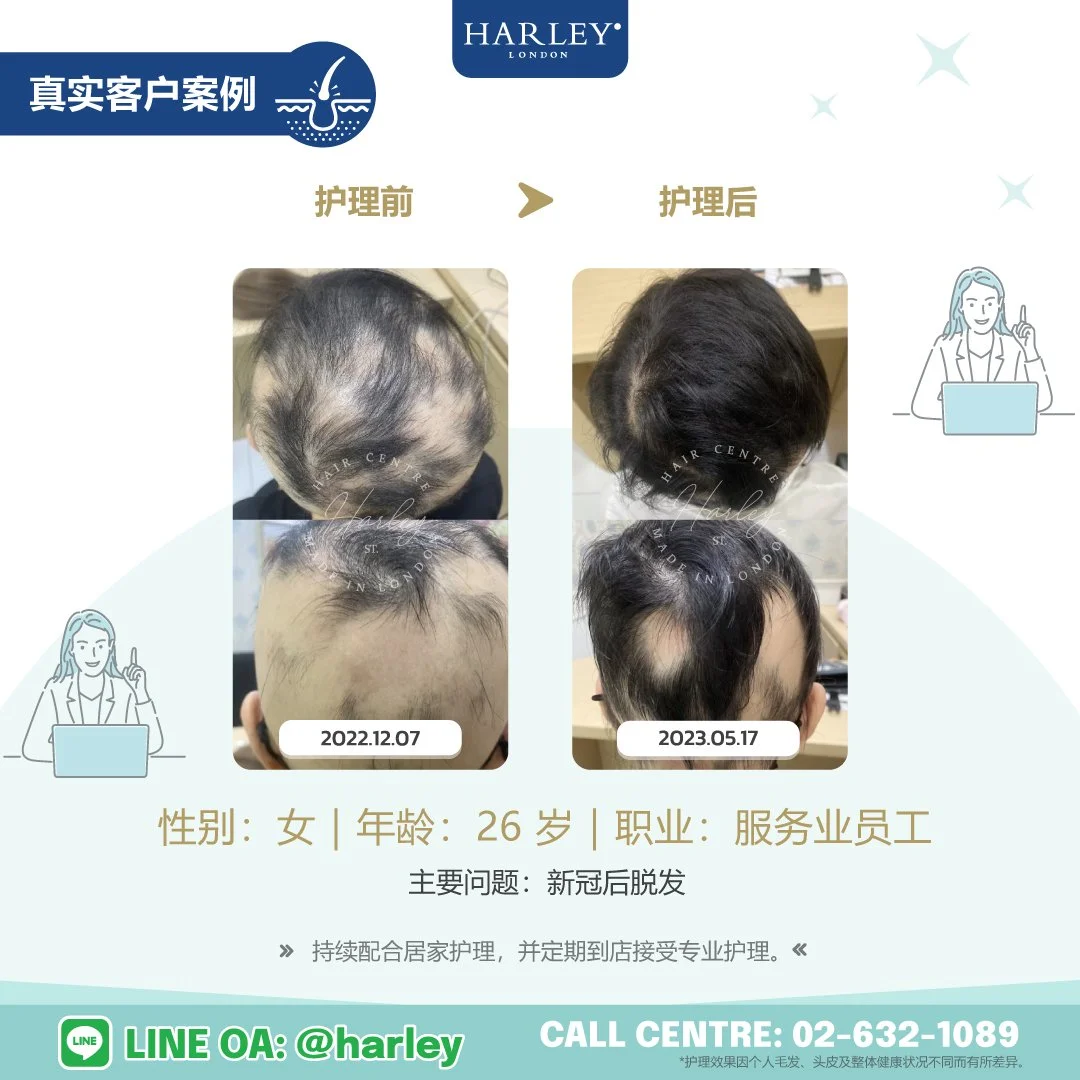 真实客户护理案例：48 岁女性，围绝经期相关脱发、头发稀疏，并伴有油性头皮。护理期间持续记录每日脱发数量，护理后粗发与细发脱落数量明显减少，展示 Harley St. Hair Centre 专业毛发与头皮护理前后的变化。
