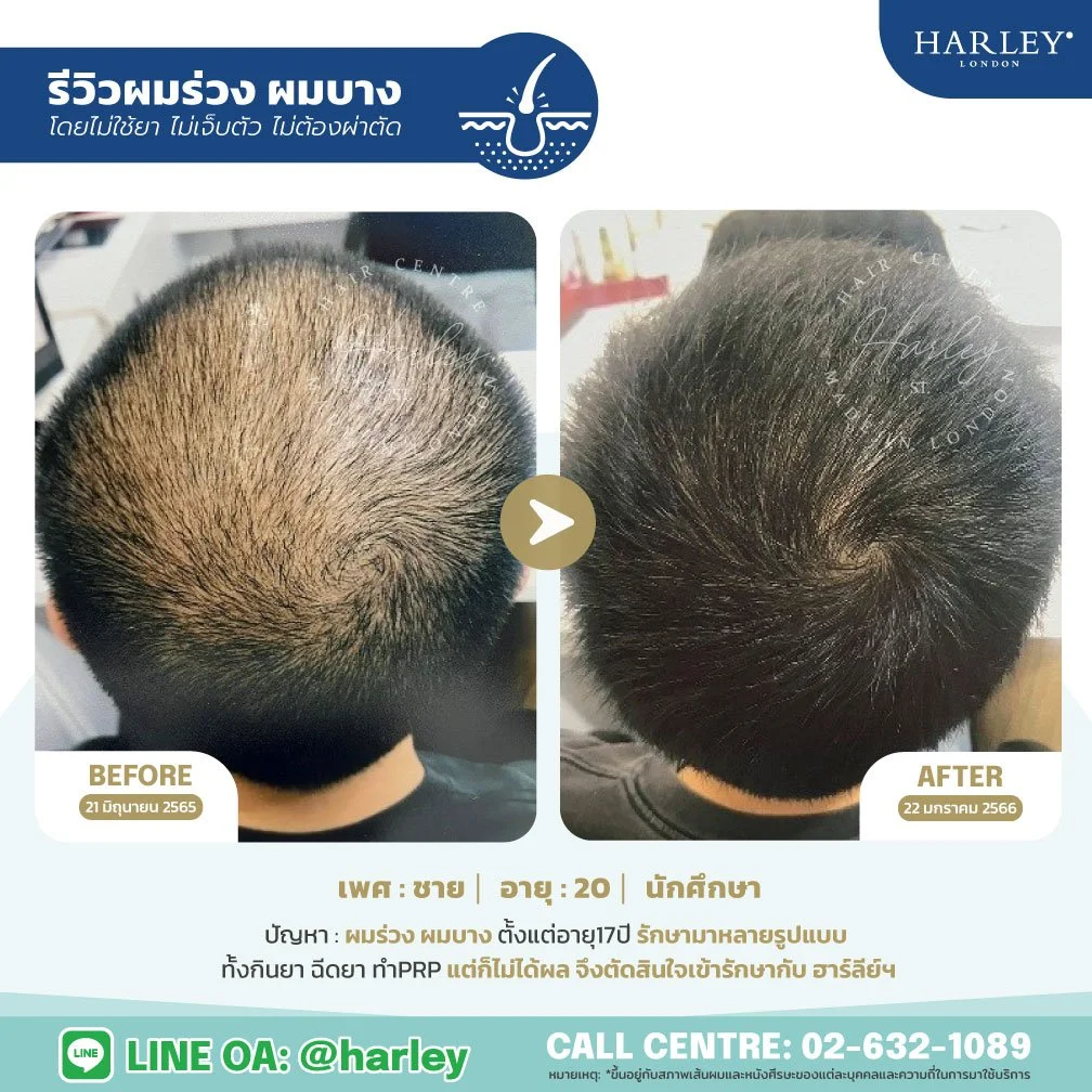รีวิวฟื้นฟูผมบางกลางศีรษะ ชายอายุ 20 ปี ย่านลาดพร้าว Harley St. Hair Centre ปากซอยลาดพร้าว 15 ไม่ใช้ยา ไม่ผ่าตัด