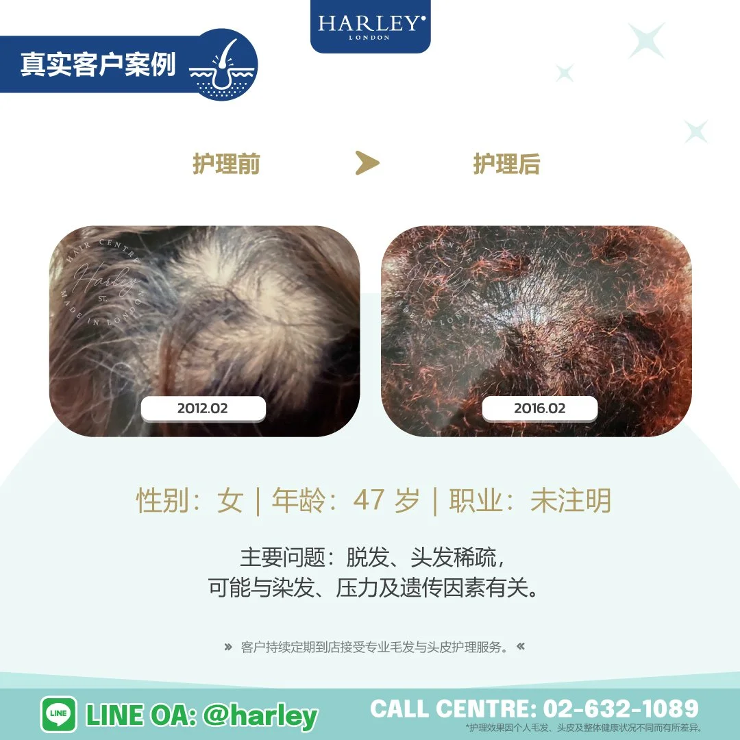 真实客户护理案例：47 岁女性，脱发、头发稀疏，可能与染发、压力及遗传因素有关。展示 Harley St. Hair Centre 专业毛发与头皮护理前后的变化。