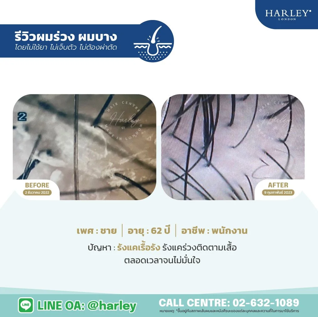 ผลส่องกล้องเช็คหนังศีรษะและรากผม รีวิวดูแลรังแคเรื้อรัง Harley St. Hair Centre สาขาลาดพร้าว 15 ใกล้ยูเนี่ยนมอลล์