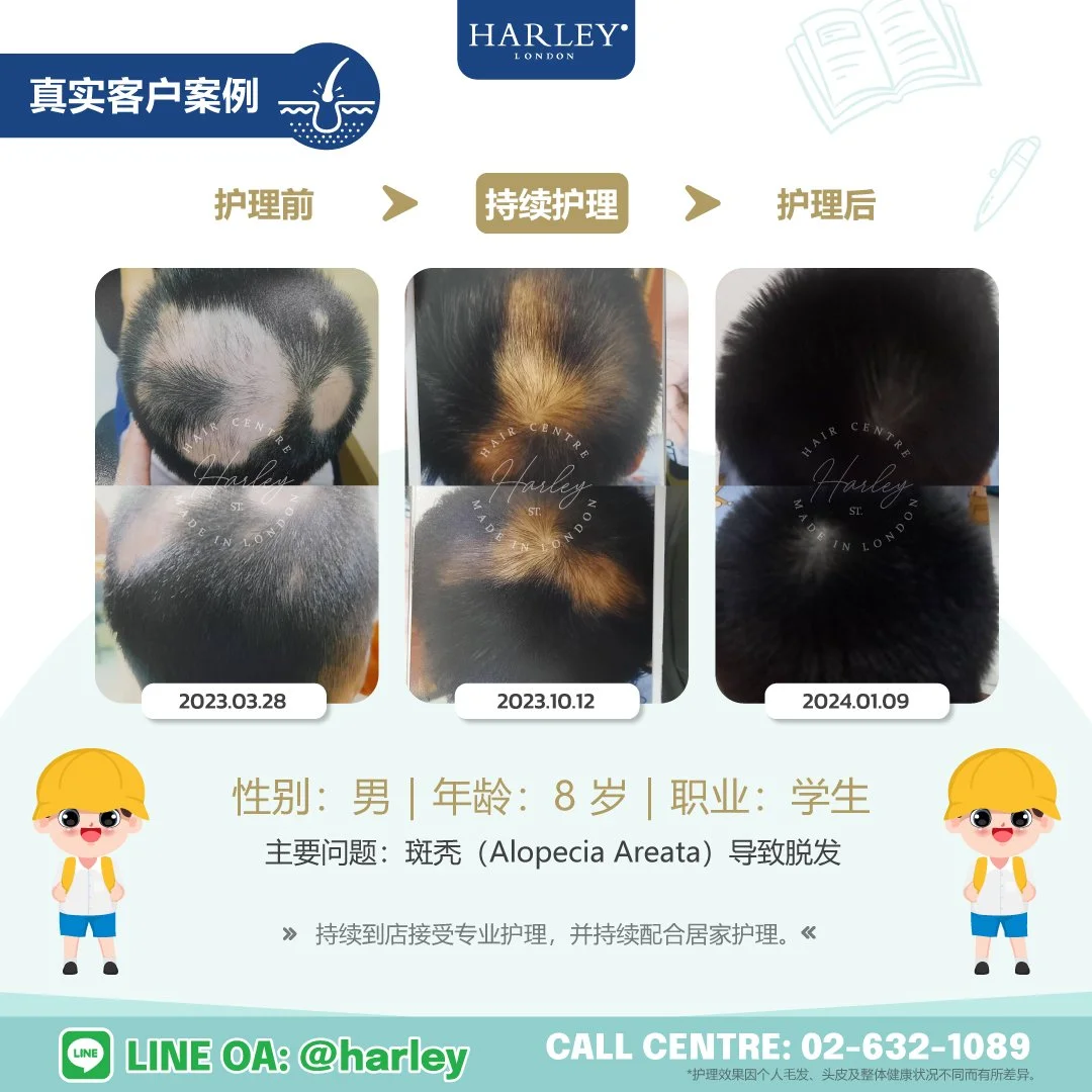 真实儿童客户案例，记录斑秃（Alopecia Areata）护理前、持续护理及护理后的恢复过程，展示头发逐步恢复的变化。