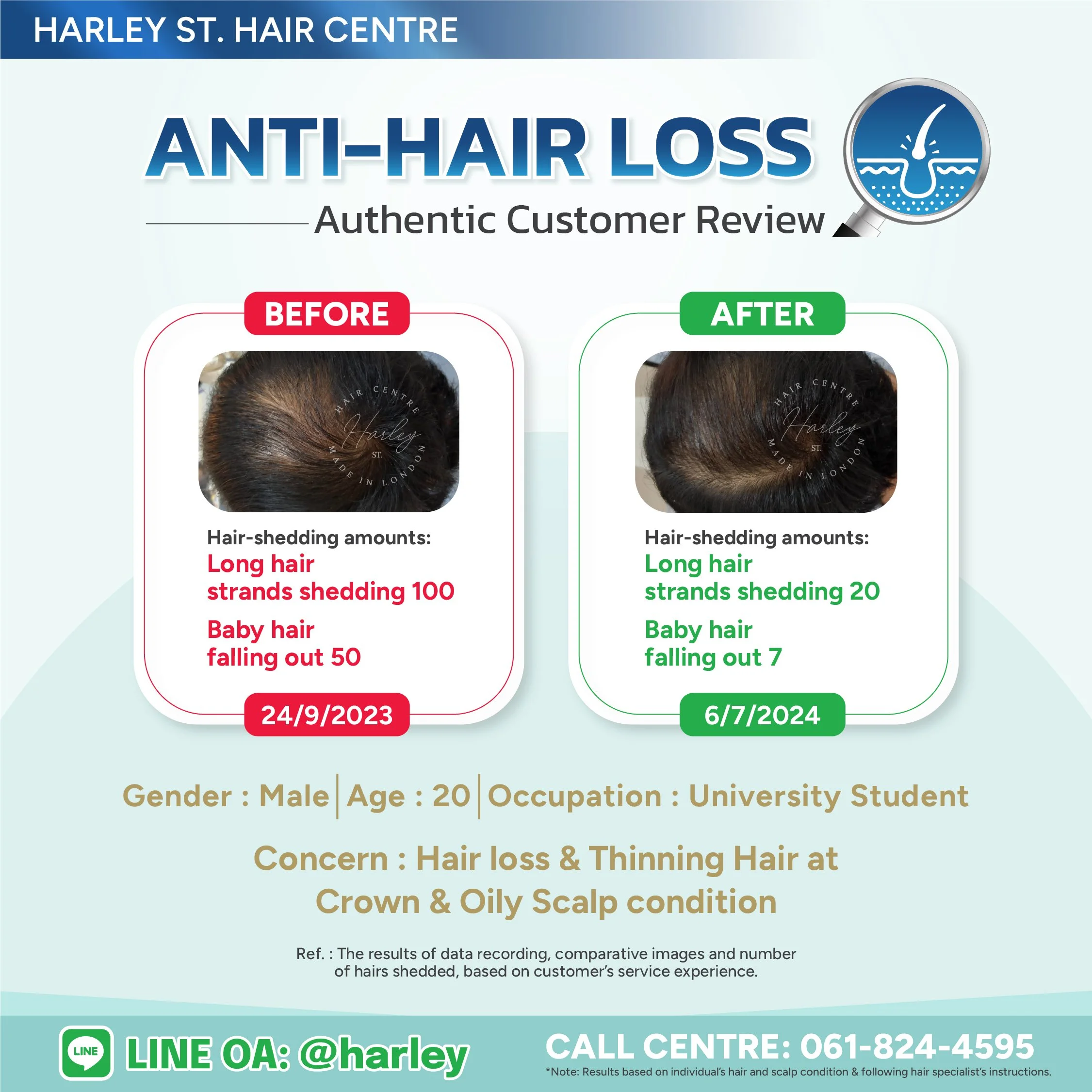 Before-and-after hair loss treatment in a 20-year-old man at Harley St. Hair Centre. Hair loss reduced from 150 to 27 strands per day, restoring thickness without surgery.