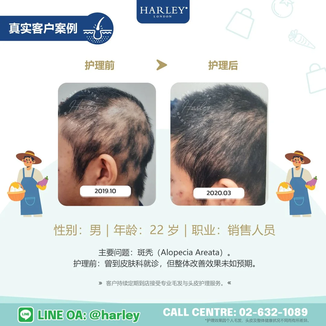 真实客户护理案例：22 岁男性，因斑秃（Alopecia Areata）导致局部脱发。护理前曾到皮肤科就诊，但整体改善效果未如预期。展示 Harley St. Hair Centre 专业毛发与头皮护理前后的变化。