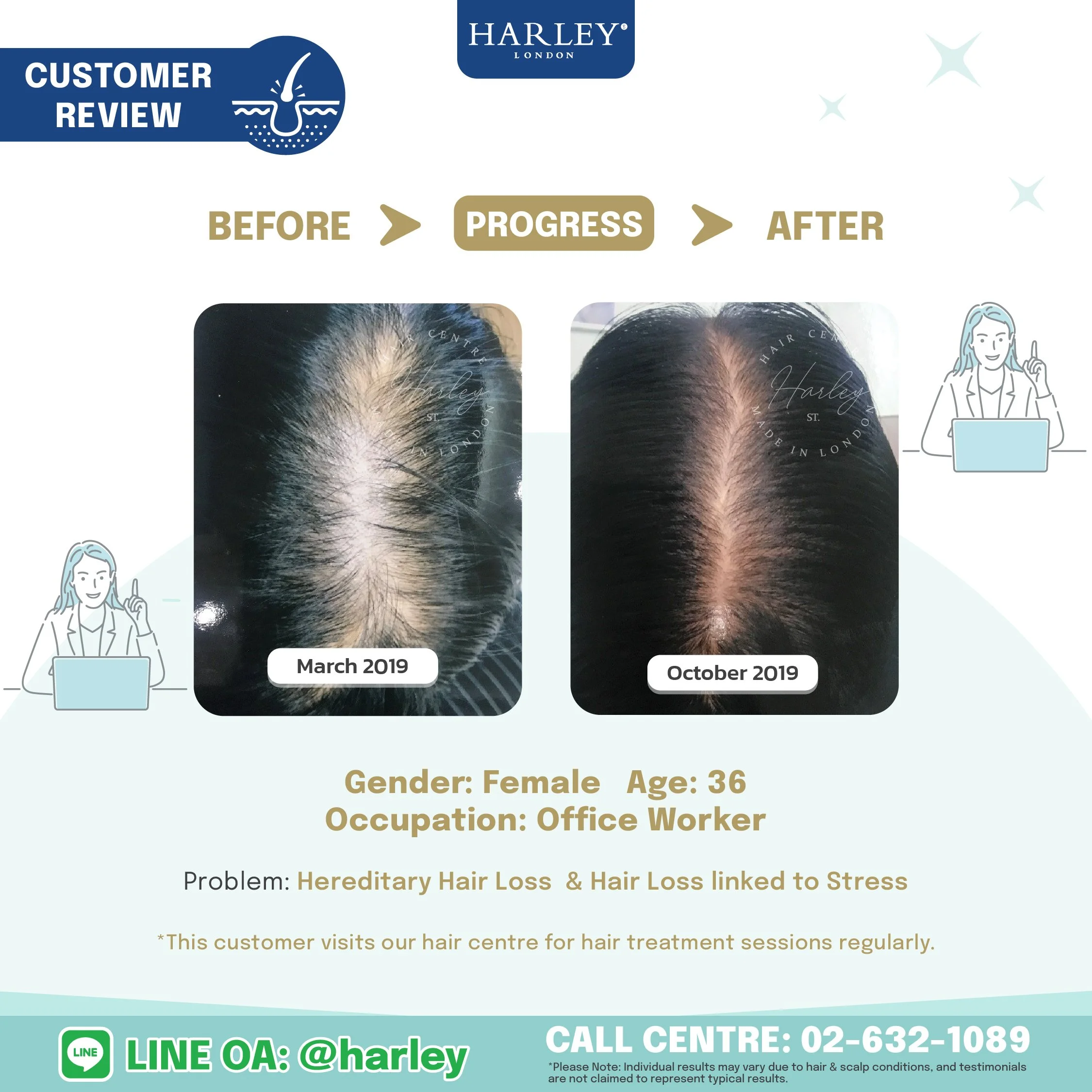 Testimonial from a 36-year-old woman with hair loss and thinning due to genetic factors. We tailored a personalized treatment plan to address her condition.