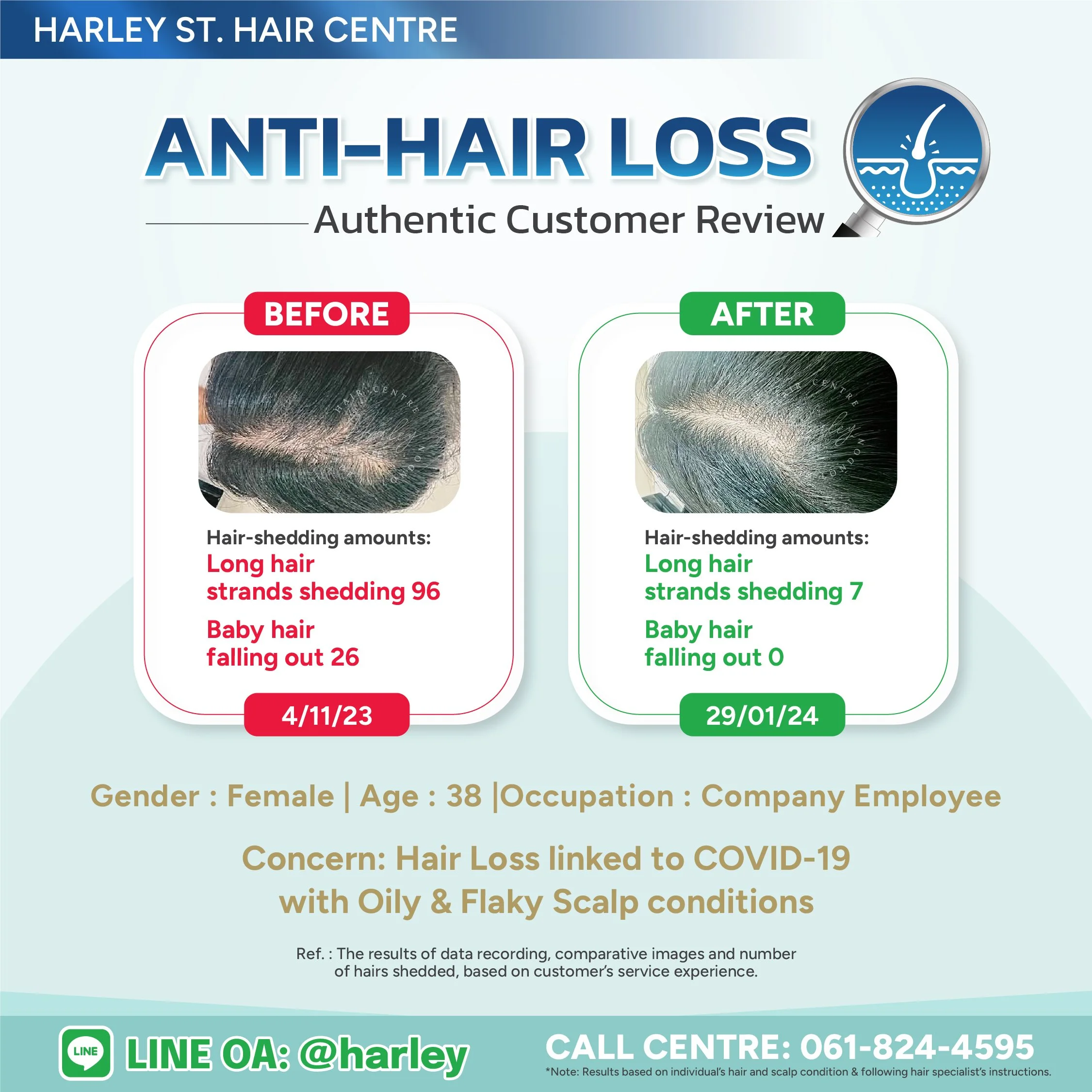 Before-and-after hair loss treatment in a 38-year-old woman at Harley St. Hair Centre. Hair loss reduced from 122 to 7 strands per day, restoring hair without surgery.