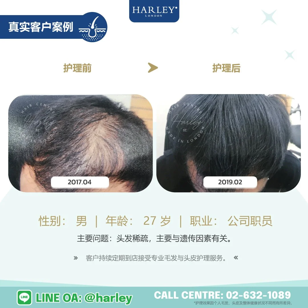 Harley St. Hair Centre Rangsit 真实客户护理案例，27 岁男性因遗传因素导致头发稀疏，接受专业毛发与头皮护理后的护理前后对比。