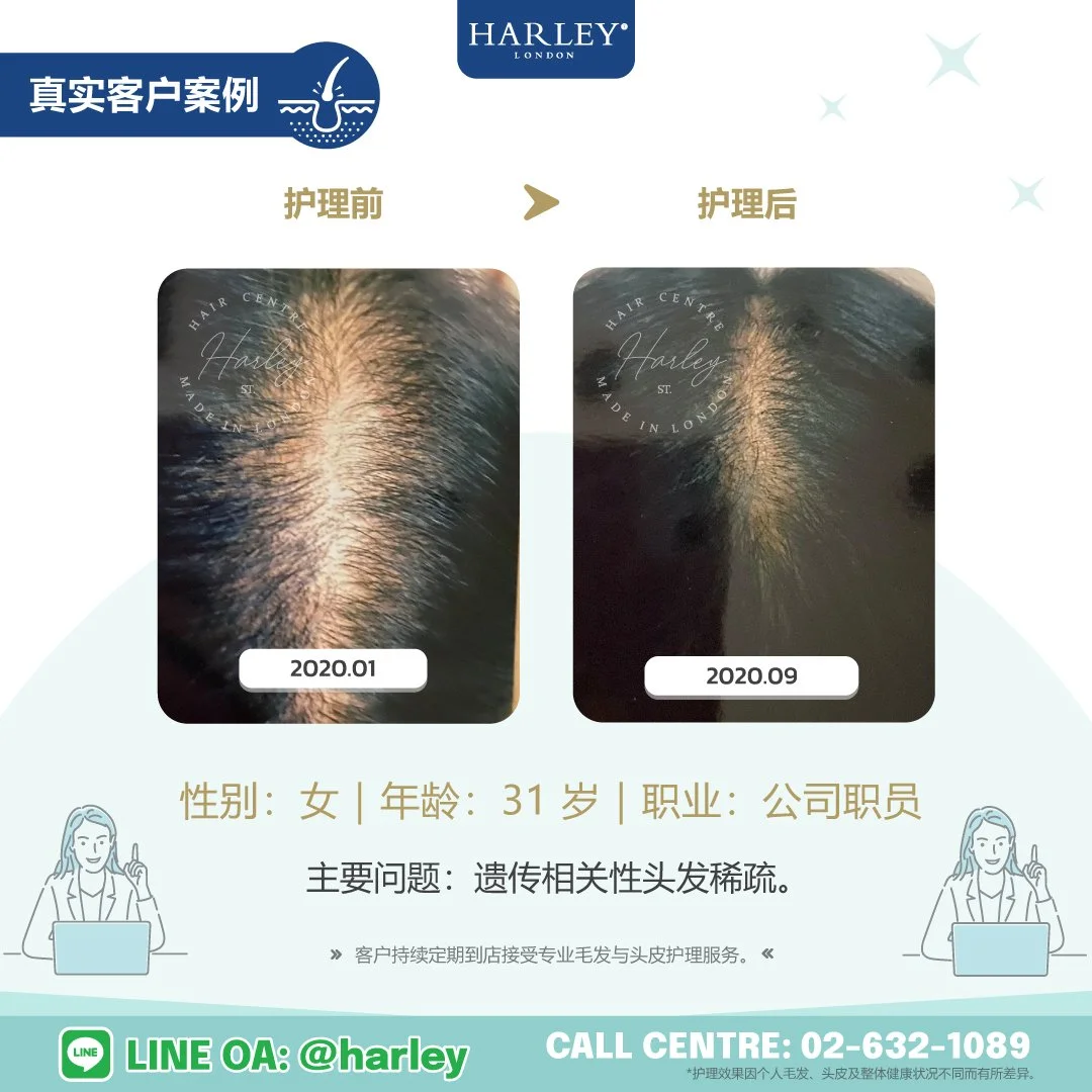 真实客户护理案例：31 岁女性，遗传相关性头发稀疏。展示 Harley St. Hair Centre 专业毛发与头皮护理前后的对比变化。