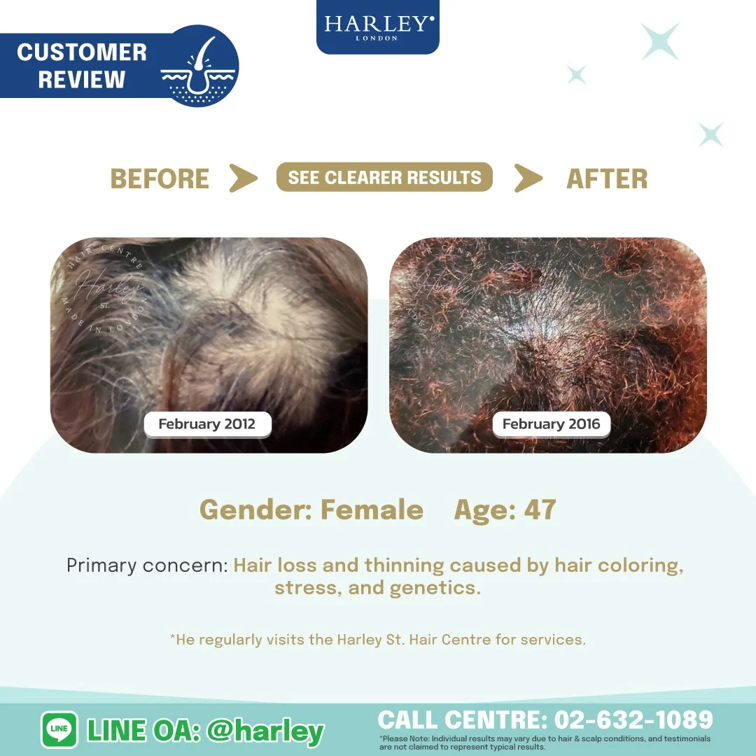 Before-and-after comparison showing the results of a female hair restoration for hair loss and Scalp Concerns caused by Hair Colouring following treatment at Harley St. Hair Centre.