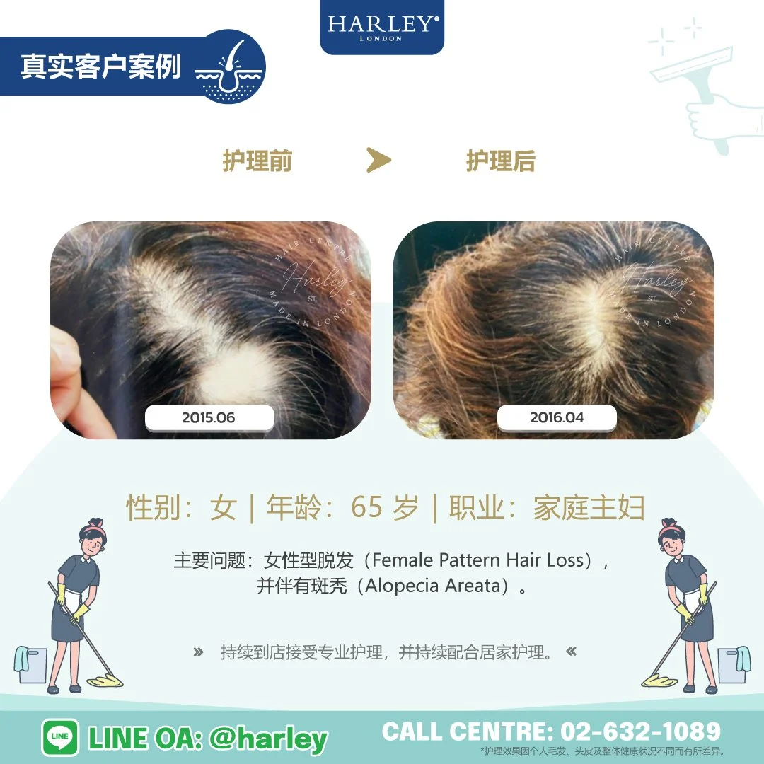 真实客户护理案例：65 岁女性，女性型脱发（Female Pattern Hair Loss）并伴有斑秃（Alopecia Areata）。展示 Harley St. Hair Centre 专业毛发与头皮护理前后的对比变化。