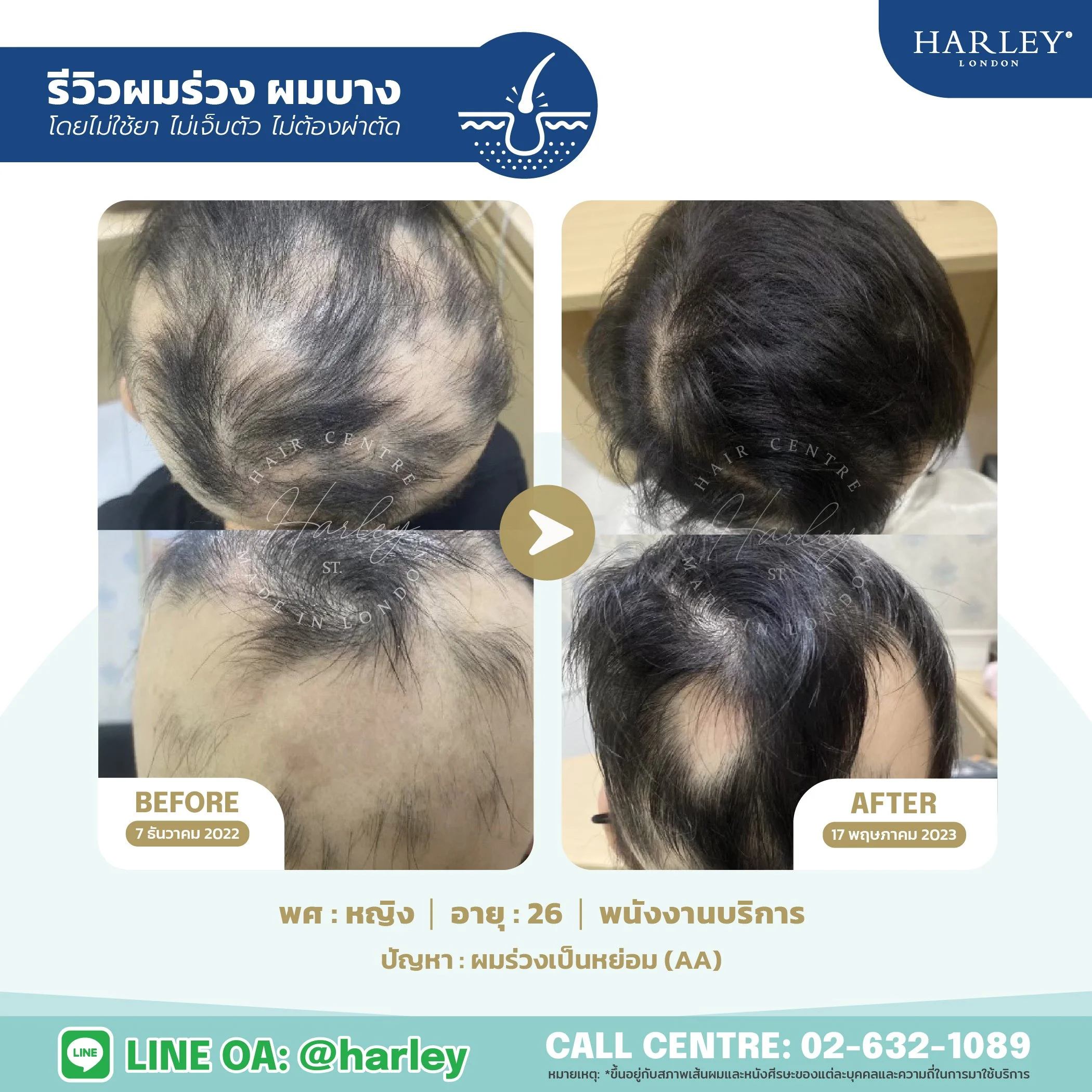 รีวิวแก้ปัญหาผมร่วงเป็นหย่อม (AA) ผู้หญิง อายุ 26 ปี อาชีพพนักงานบริการ โดย Harley St. Hair Centre เปรียบเทียบภาพก่อนและหลังรักษา เส้นผมกลับมาหนาขึ้นโดยไม่ใช้ยา