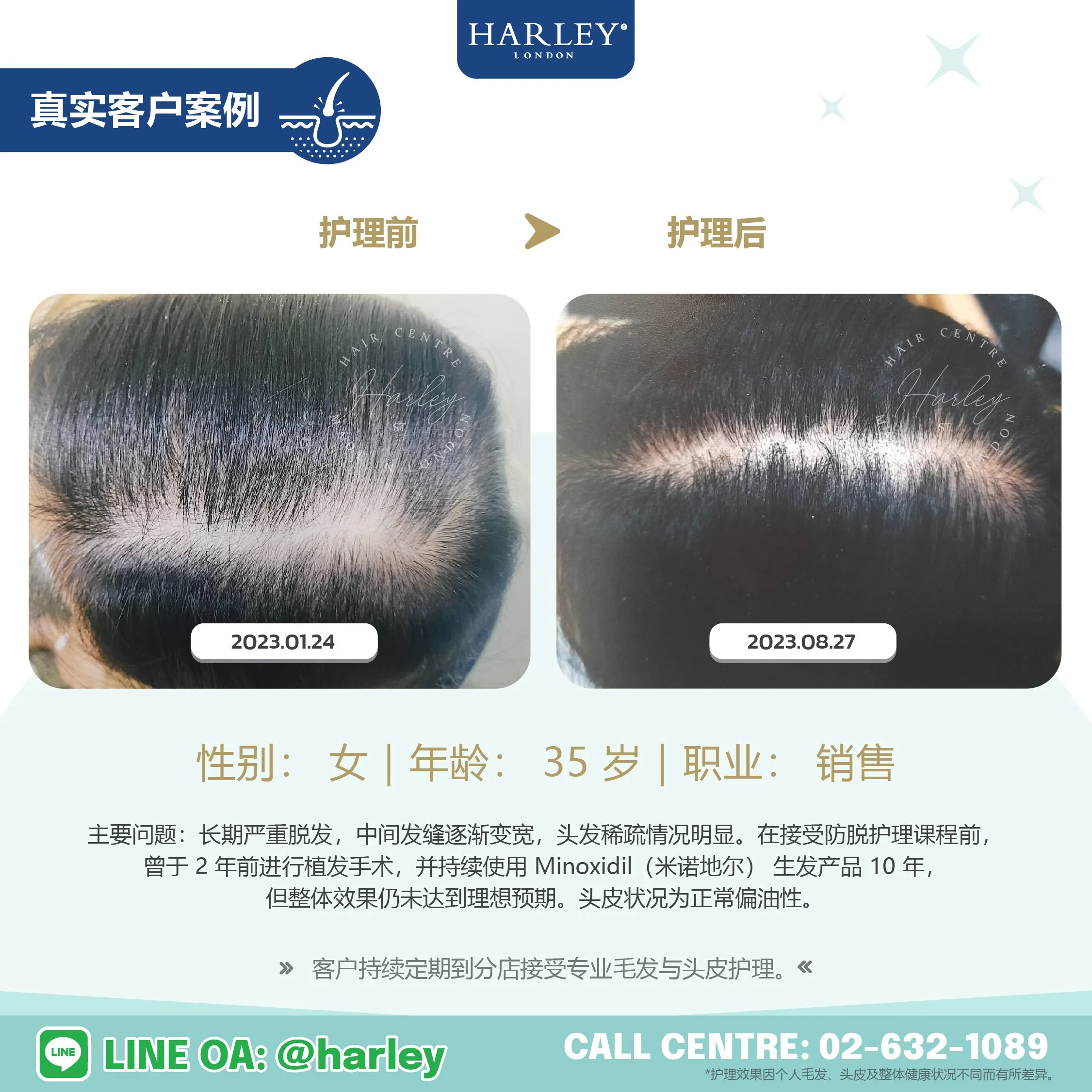 35 岁女性客户头发稀疏护理前后真实案例，发缝逐渐改善，接受 Harley St. Hair Centre 专业毛发与头皮护理。