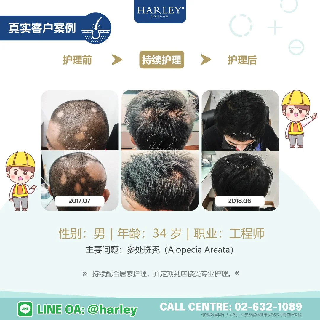 真实男性客户案例，展示多处斑秃（Alopecia Areata）护理前、持续护理及护理后的恢复过程，头发逐步恢复生长。