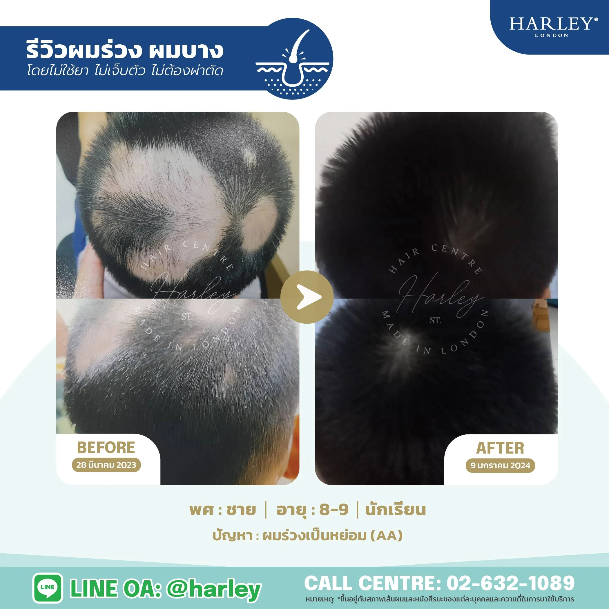 รีวิวรักษาผมร่วงเป็นหย่อม (AA) ในเด็กผู้ชาย อายุ 8-9 ปี วัยเรียน โดย Harley St. Hair Centre ผลลัพธ์เปรียบเทียบภาพ Before และ After แบบไม่ใช้ยา ไม่เจ็บตัว ไม่ต้องผ่าตัด