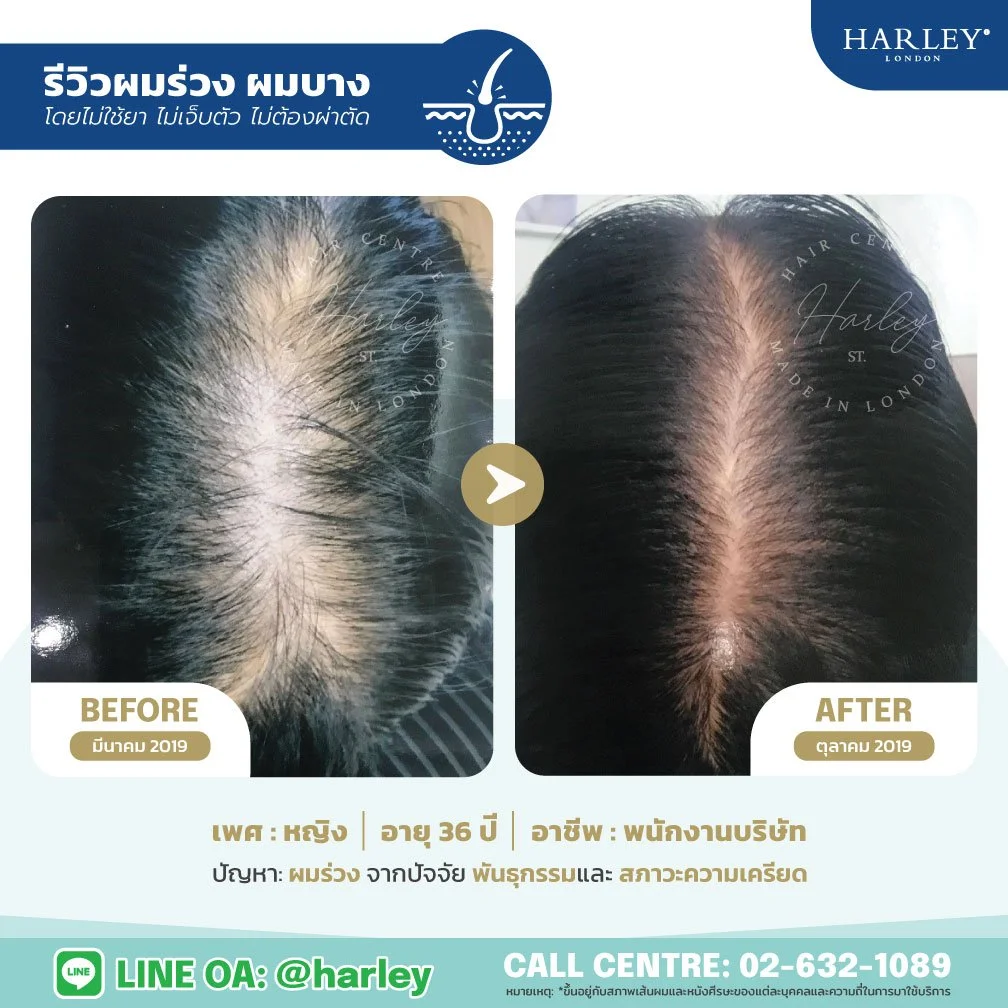 รีวิวผลลัพธ์การรักษาผมร่วงผมบางในผู้หญิง อายุ 36 ปี ที่ Harley St. Hair Centre สาขารังสิต รอยแสกแคบลงและผมดูหนาขึ้นชัดเจนโดยไม่ต้องใช้ยาหรือผ่าตัด