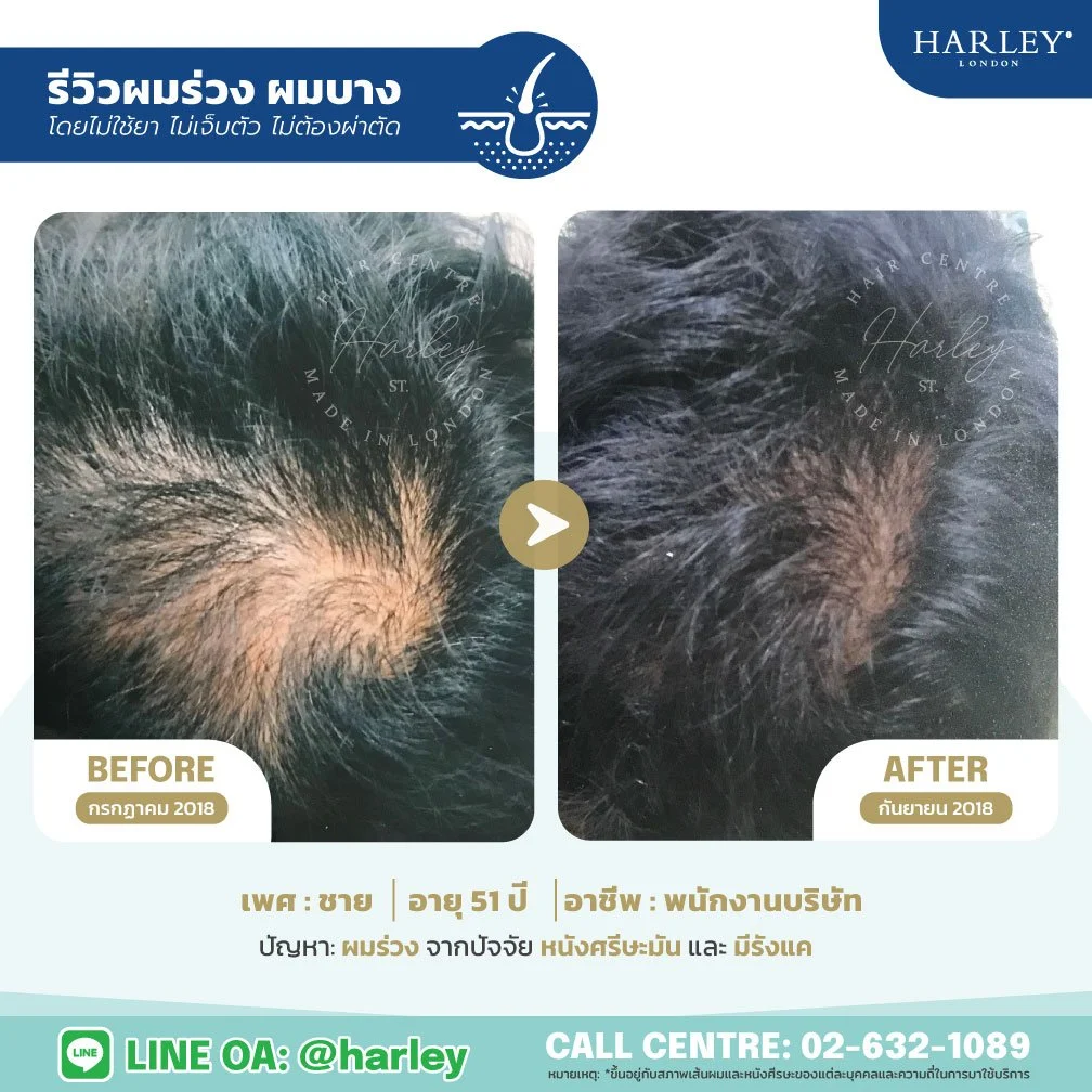 รีวิวแก้ปัญหาผมร่วงในผู้ชาย อายุ 51 ปี ที่มีสาเหตุจากหนังศีรษะมันและรังแคเรื้อรัง ด้วยโปรแกรมฟื้นฟูรากผมที่ Harley St. Hair Centre สาขารังสิต ผลลัพธ์ก่อนและหลังการรักษาภายใน 2 เดือน โดยไม่ต้องผ่าตัด