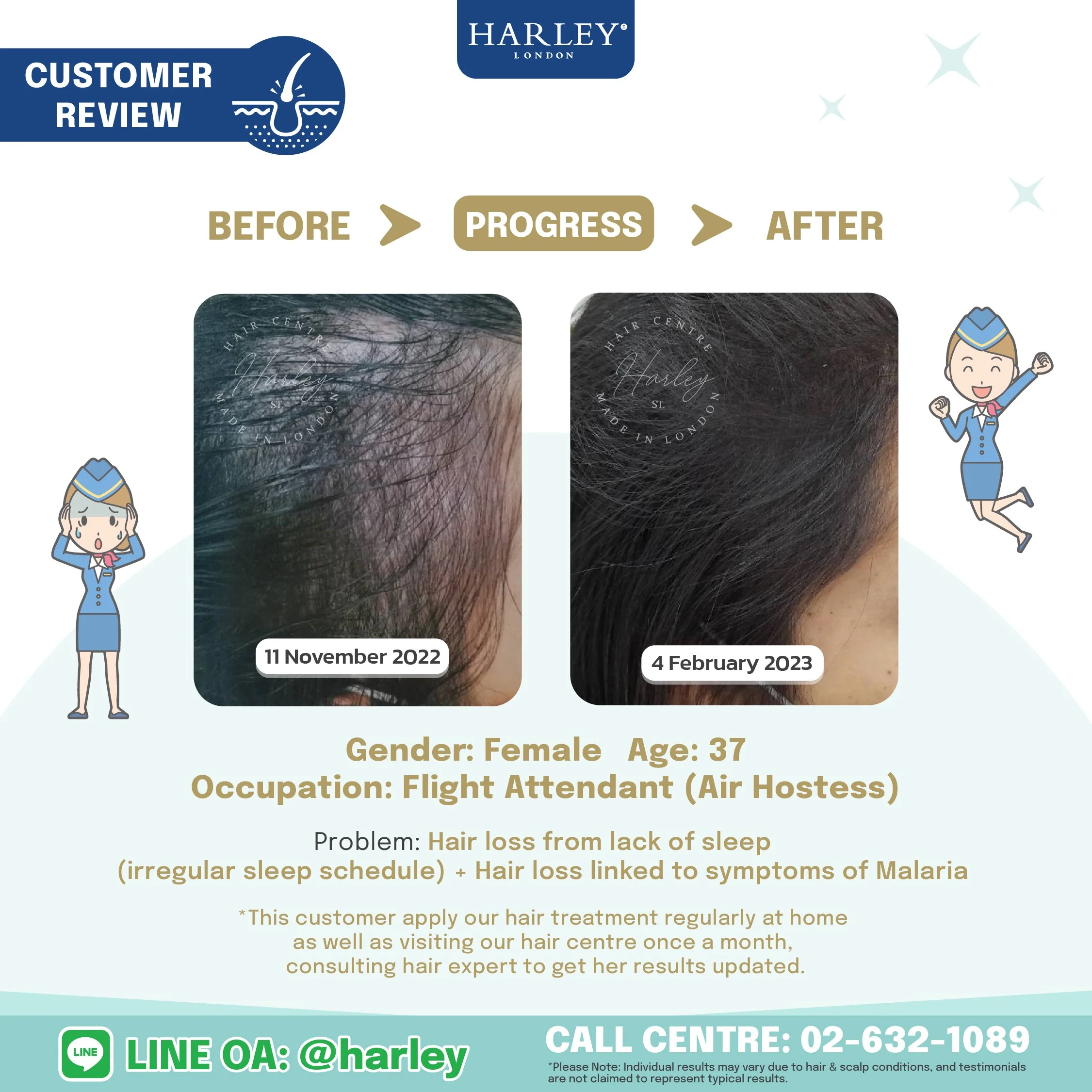 Testimonial from a 37-year-old woman experiencing hair loss and frontal thinning due to lack of sleep and irregular sleep patterns. Our Anti Hair Loss Program helped restore her hair without the need for a hair transplant or surgery.