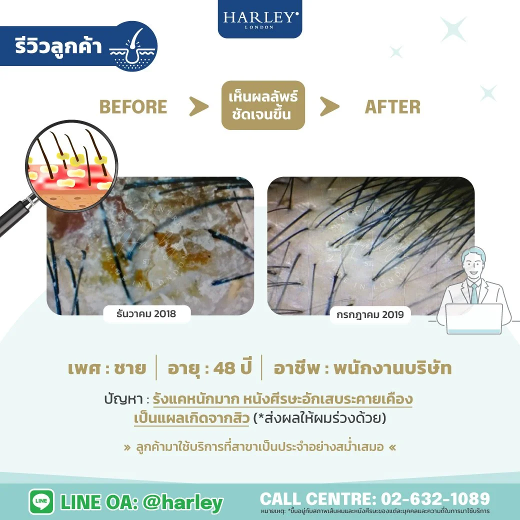 ภาพส่องกล้องตรวจรากผม แก้ปัญหารังแคและหนังศีรษะอักเสบ ชาย 48 ปี Harley St. Hair Centre สาขาบางนา
