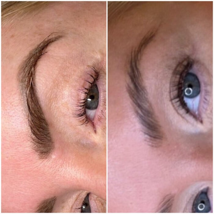 Laser-tattoo-removal-brows-700x700.jpg