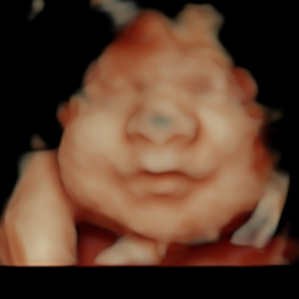 A 5D ultrasound image of a baby in the womb.