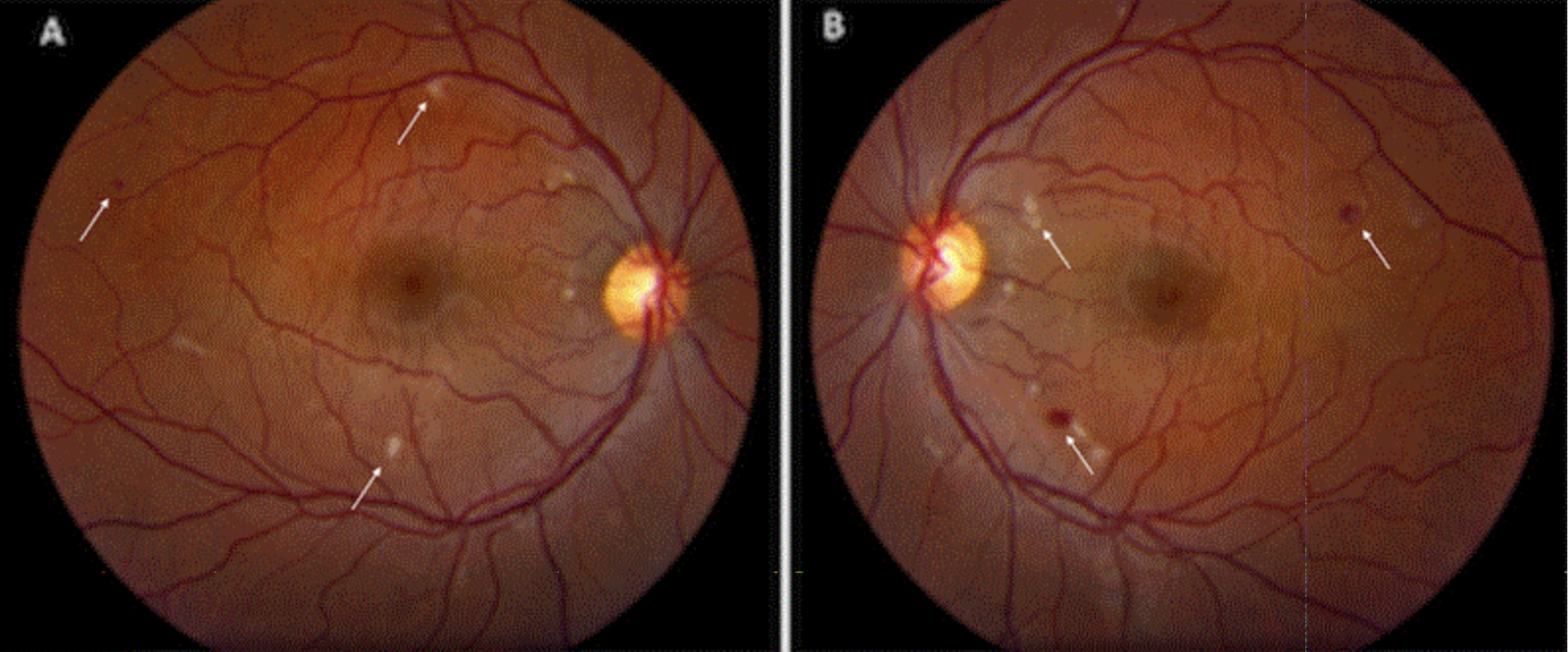 Cosmetic patient sues doctor, nurse after Restylane® injection left her blind in one eye