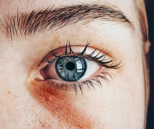 Vision Loss and Blindness Following Fillers