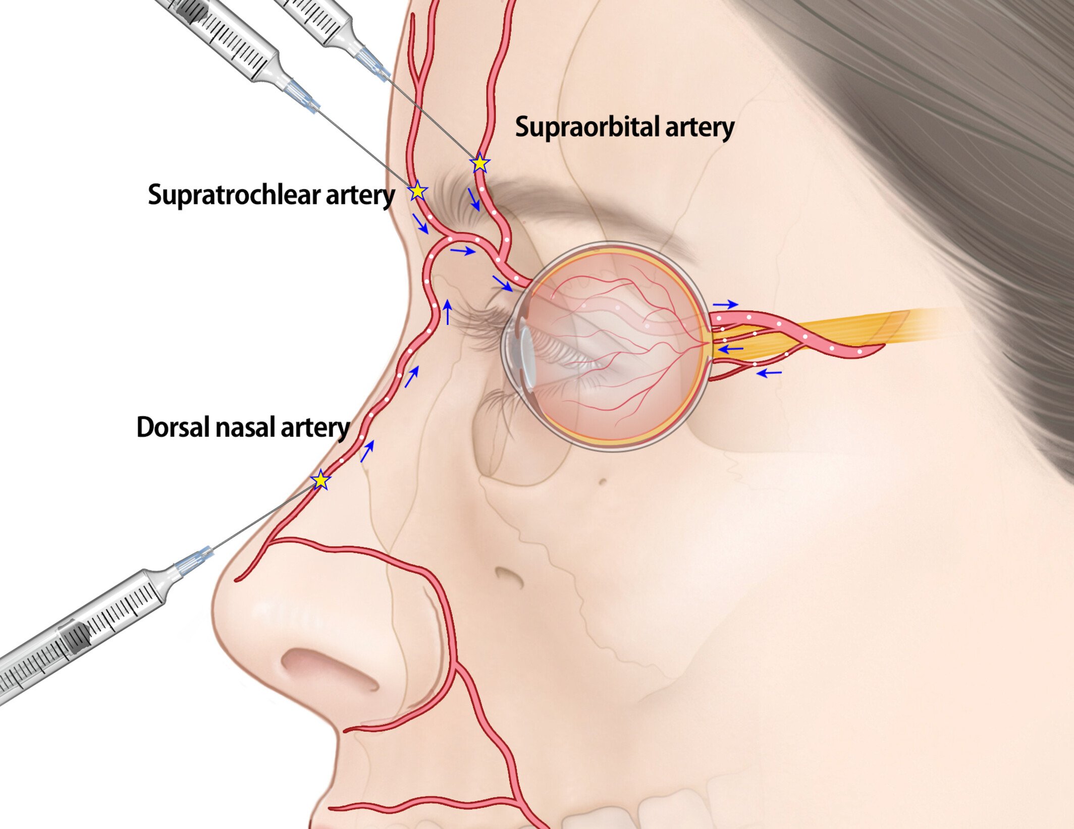 FDA Executive Summary General Issues Panel Meeting on Dermal Filler