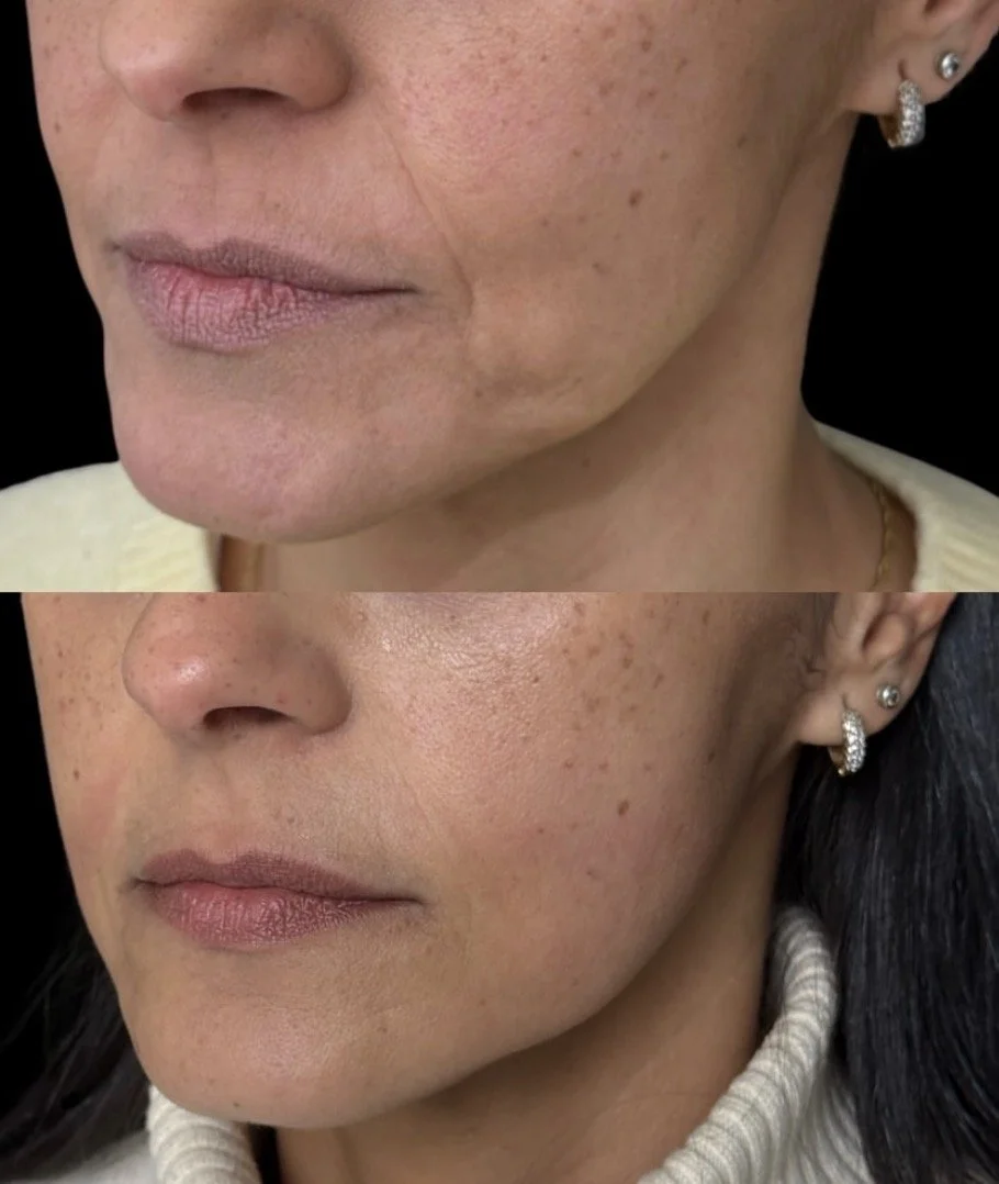 Vorher-Nachher-Vergleich der Haut, zeigt Verbesserungen bei der Hauttextur und Fleckenentfernung bei einer Frau mit dunklen Haaren und Ohrringen.