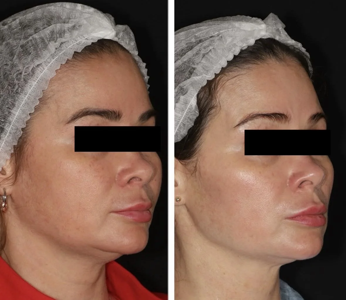 Vorher-Nachher-Bilder eines Gesichts, das eine Hautbehandlung zeigt, mit leichtem Hautglanz und Texturverbesserung, getragenem weißen Haarband