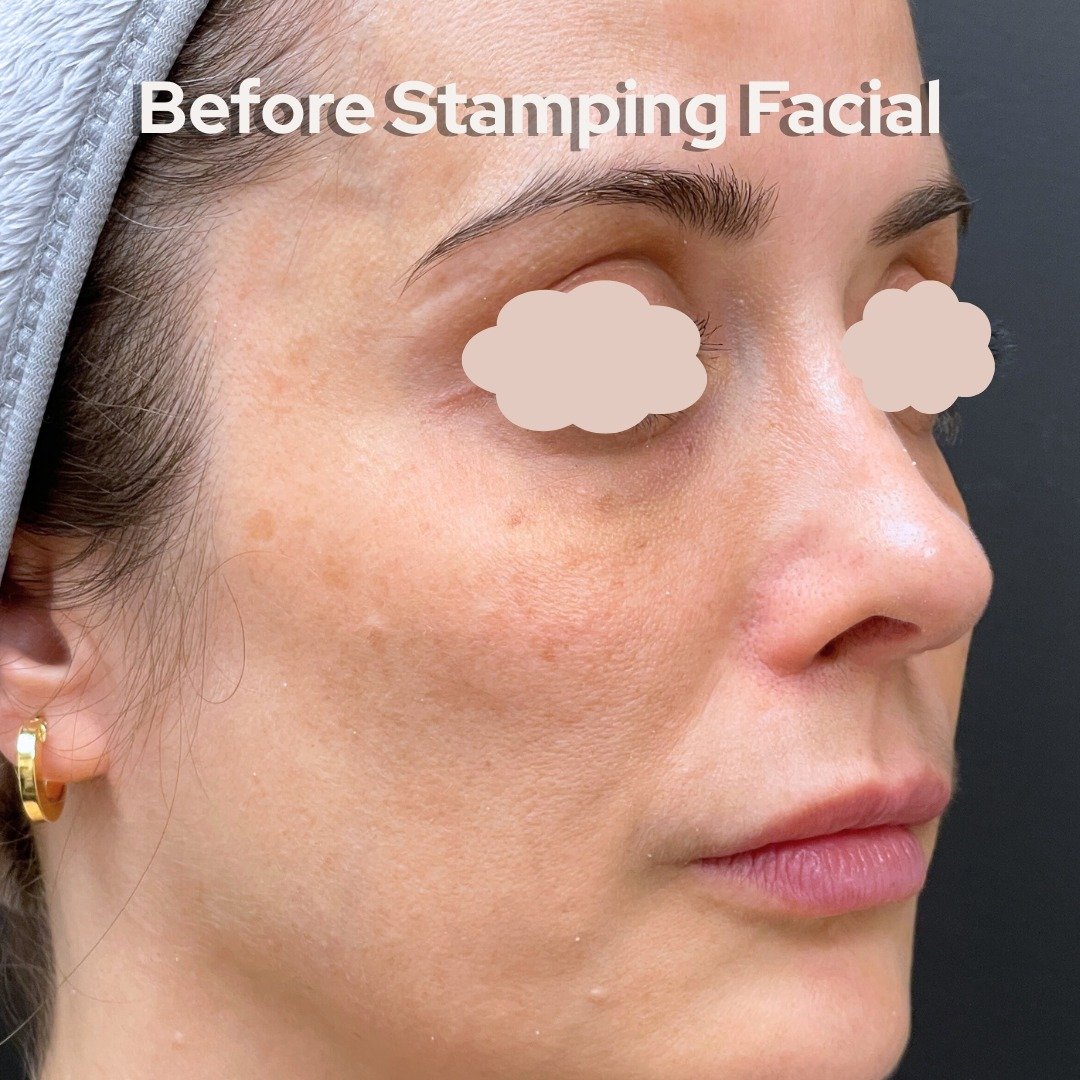 ✨ Stamping Laser Facial &ndash; Your Glow-Up Starts Here! ✨
Swipe to see how this powerful treatment helps with:
🌟 Skin tightening
🌟 Texture refinement
🌟 Pore size reduction
🌟 Brightening &amp; rejuvenation

A no-downtime facial that packs a punc