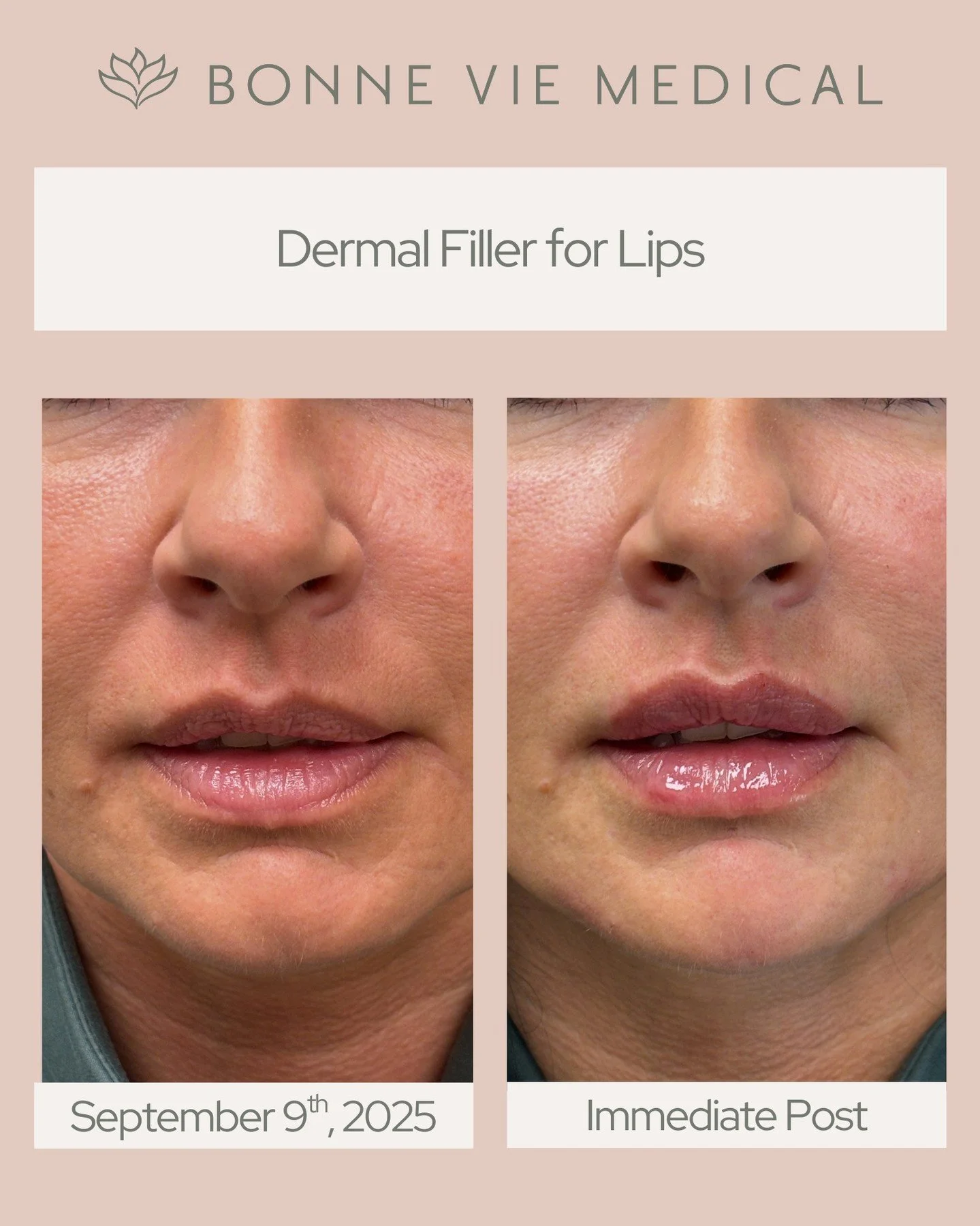 Natural, beautifully balanced lips&mdash;instantly. 💋
Our dermal filler treatment enhances shape and volume for a refreshed, hydrated look you can see right away.

#bonneviemedical #medicalaesthetics #medispa #dermalfiller #lipfiller #naturallook #s