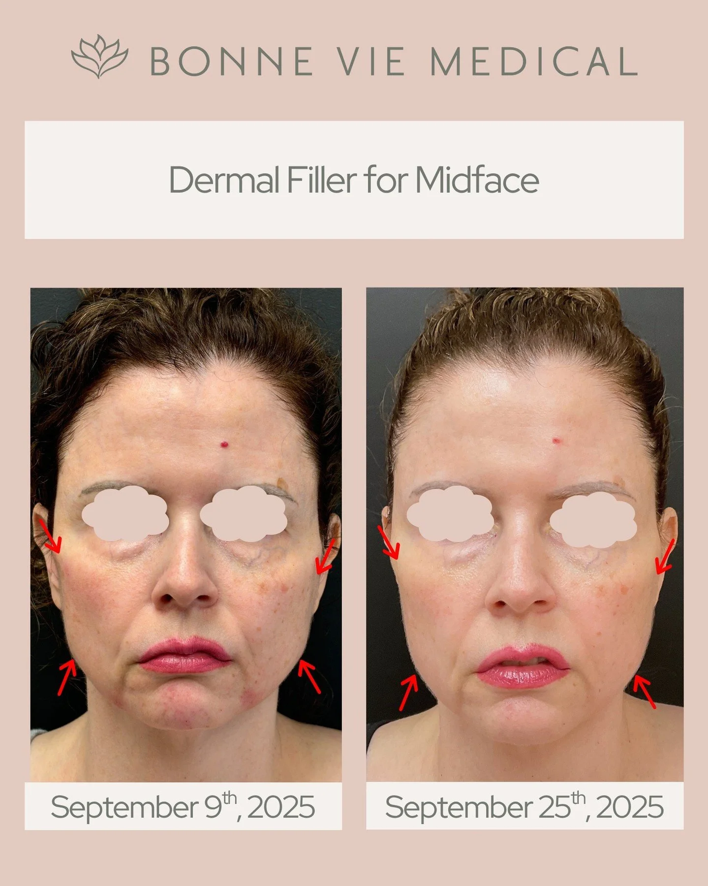 Subtle lift, stunning results.💉Midface dermal fillers restore volume and balance, giving a naturally refreshed, youthful look.
#BonneVieMedical #DermalFiller #MidfaceFiller #FacialRejuvenation #NaturalResults #MedicalAesthetics #YouthfulSkin #Facia
