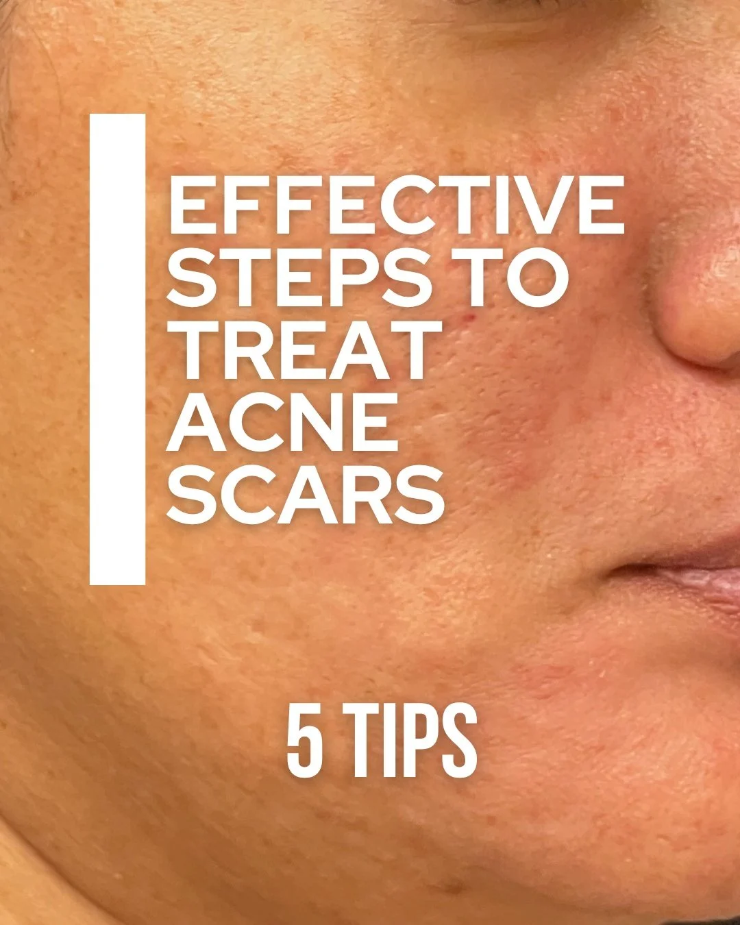 Struggling with acne scars? You’re not alone — and there are effective ways to treat them.
Swipe through to discover proven treatments that help smooth, renew, and restore your skin’s natural glow. ✨
#AcneScarTreatment #SkinRejuve