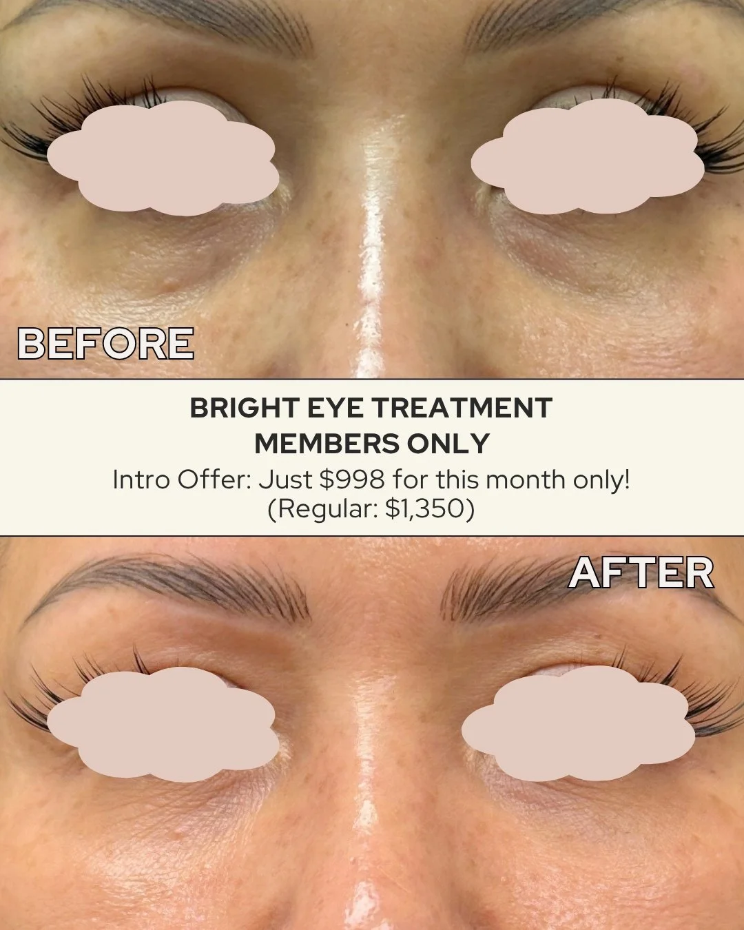 𝗜𝗻𝘁𝗿𝗼𝗱𝘂𝗰𝗶𝗻𝗴 𝗢𝘂𝗿 𝗡𝗲𝘄 𝗕𝗿𝗶𝗴𝗵𝘁 𝗘𝘆𝗲 𝗧𝗿𝗲𝗮𝘁𝗺𝗲𝗻𝘁!
This treatment targets dark circles, fine lines, and hollowness for a naturally rejuvenated look.

💎 𝗠𝗲𝗺𝗯𝗲𝗿𝘀 𝗢𝗻𝗹𝘆 𝗜𝗻𝘁𝗿𝗼 𝗢𝗳𝗳𝗲𝗿: $𝟵𝟵𝟴 (𝗥𝗲𝗴. $𝟭,𝟯?