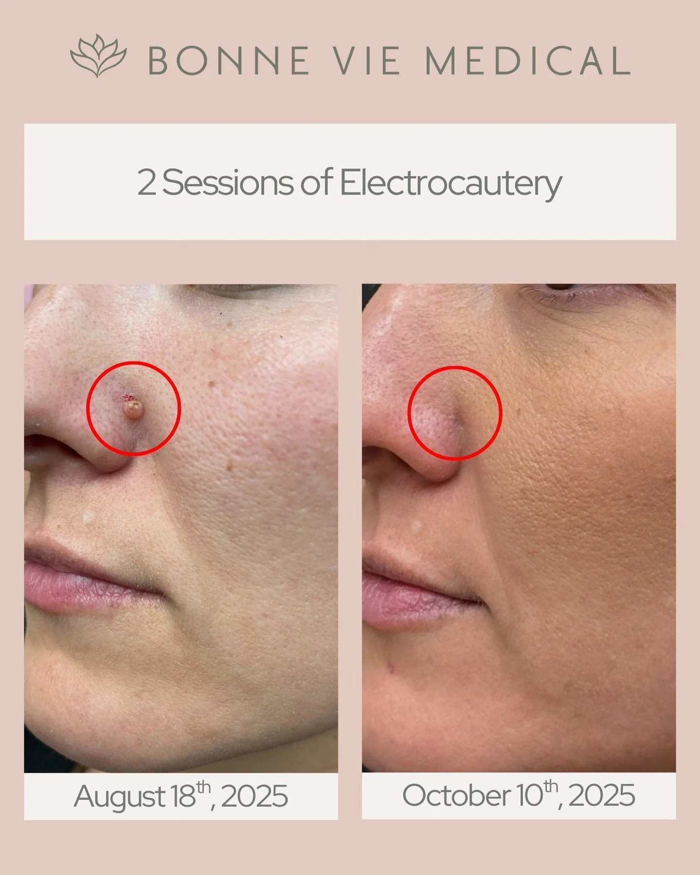 Electrocautery Results After Just 2 Sessions ✨

A gentle, precise treatment that targets skin lesions with minimal downtime.
Clearer, smoother, more confident skin. Safely and effectively.

#BonneVieMedical #Electrocautery #SkinLesionRemoval #SkinTre