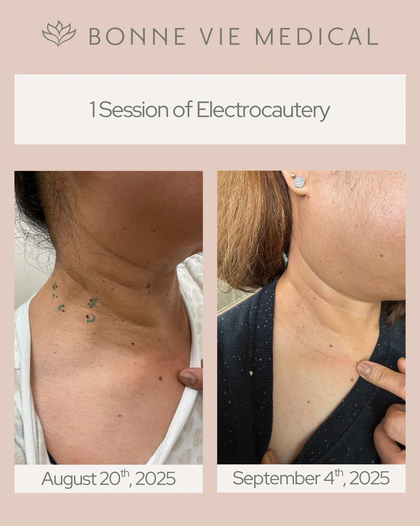 ✨ One Session, Visible Results ✨

Electrocautery can safely and effectively remove unwanted skin tags and lesions with minimal downtime.

See the improvement between August 20th and September 4th. Smoother, clearer skin in just one treatment. Your sk