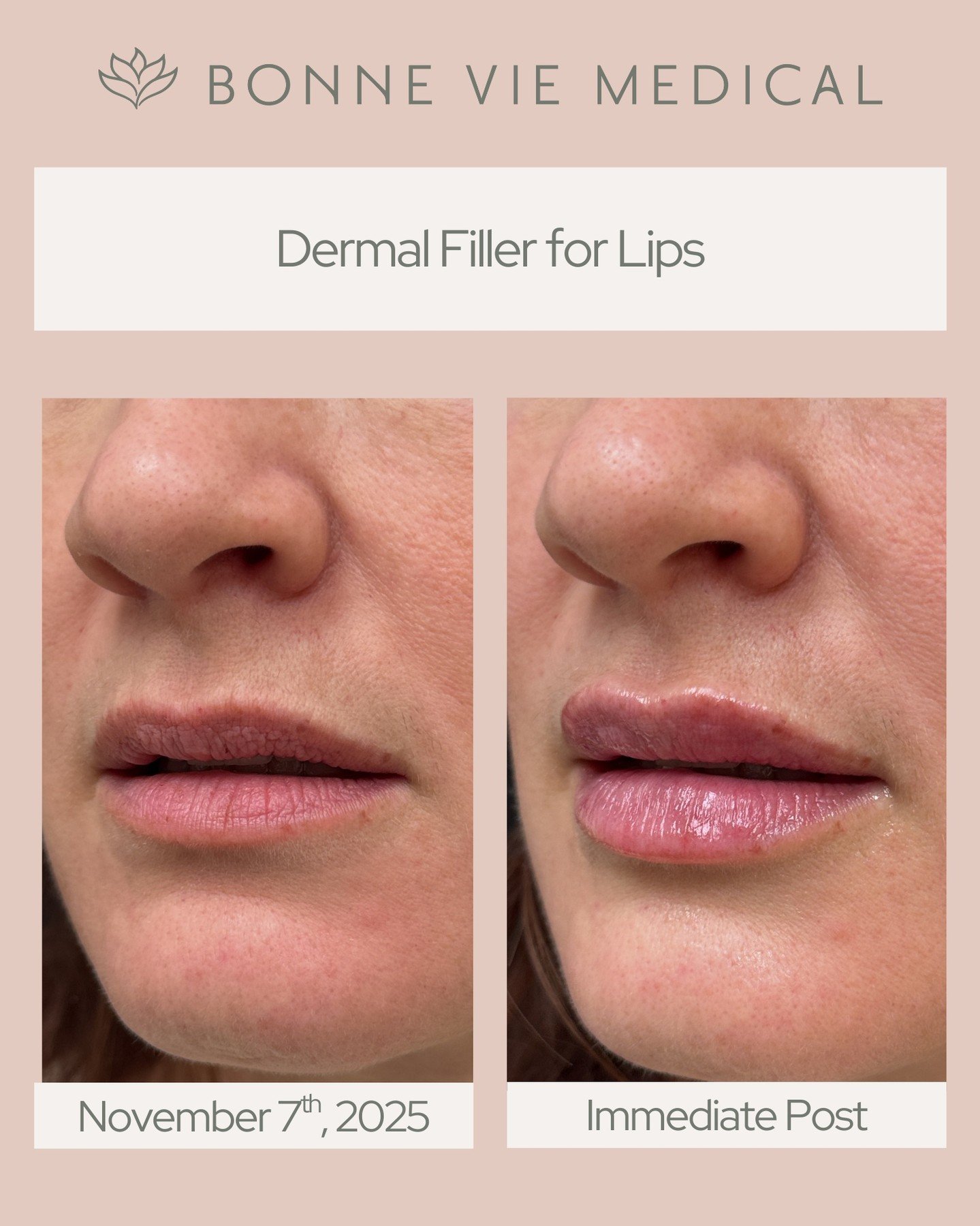 💋 Naturally Enhanced Lips
A touch of filler can bring subtle volume, smoother borders, and a more balanced shape while keeping everything looking soft and authentic.

Look at this beautiful, natural result. Your lips, just a little more you.

#Bonne