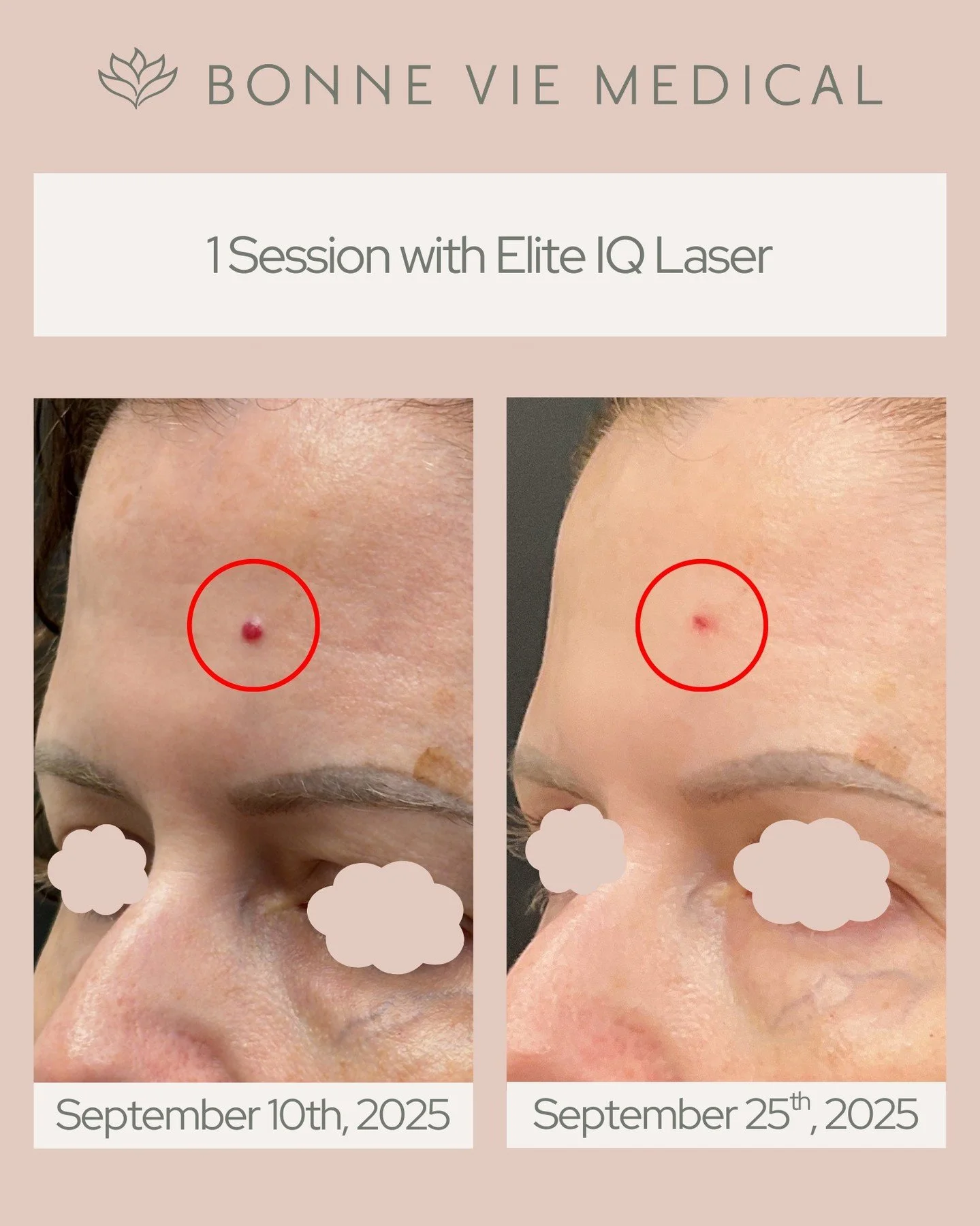 One session. Beautiful progress. 💫
Our Elite IQ Laser delivers targeted clarity with little to no downtime - perfect for restoring smooth, even-toned skin.

#EliteIQLaser #LaserSkinTreatment #SkinClarity #AestheticResults #BeforeAndAfter #BonneVieMe