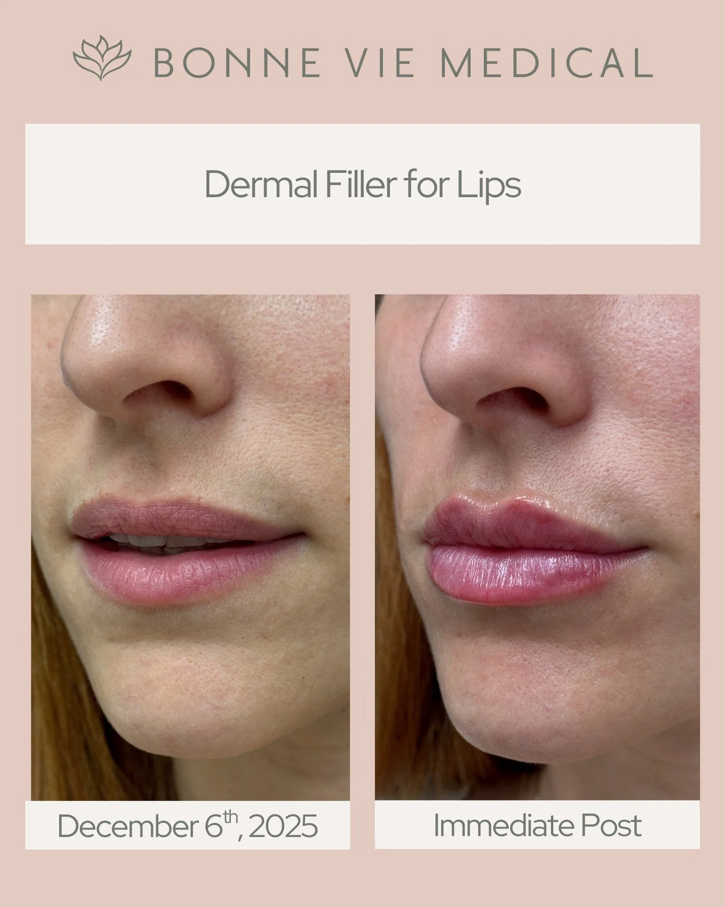 Naturally pouty. Beautifully defined. ✨
This is what subtle lip filler looks like.

#LipGoals #BeforeAndAfter #BonneVieMedical #SoftEnhancement #LipFillerResults
