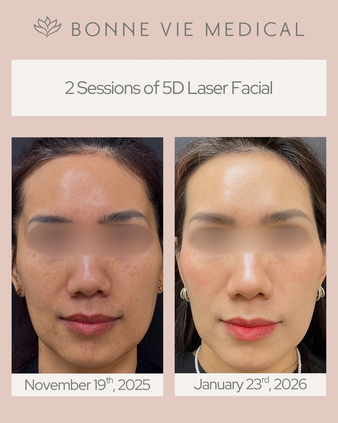 ✨ Visible results after just 2 sessions of 5D Laser Facial.
Notice improved tone, texture, and overall skin clarity; refined, refreshed, and naturally radiant.

#5DLaserFacial #BeforeAndAfter #BonneVieMedical #SkinRejuvenation #LaserResults #HealthyS