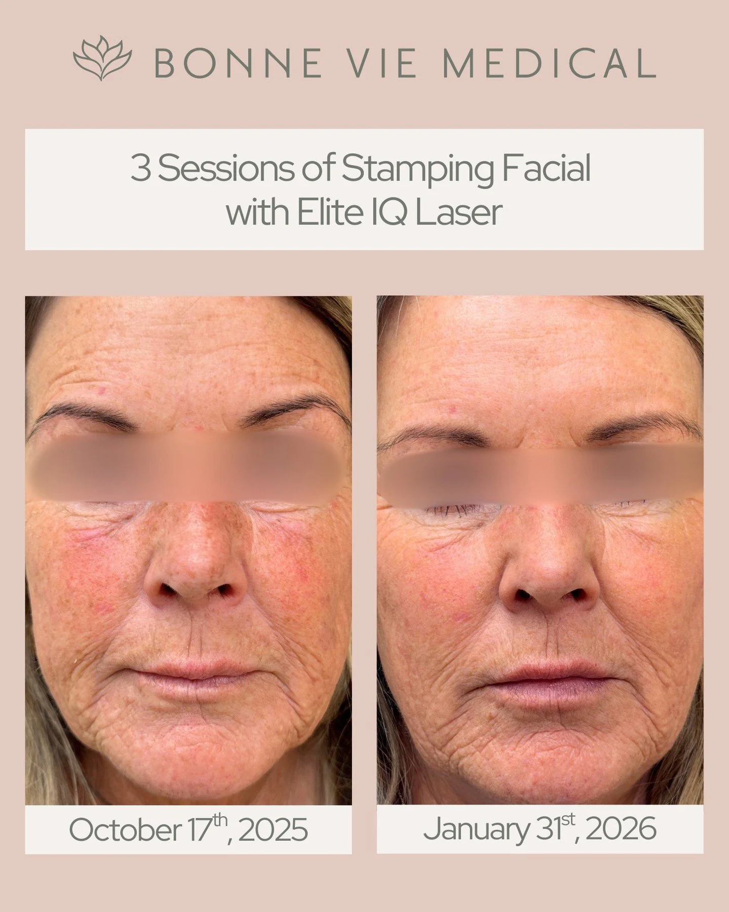 ✨ Laser Facial Rejuvenation for Sun Spot Removal ✨
Visible improvement after a series of Stamping Facials with the Elite iQ Laser. This treatment targets sun damage, uneven pigmentation, and overall skin tone - revealing a clearer, brighter, more eve