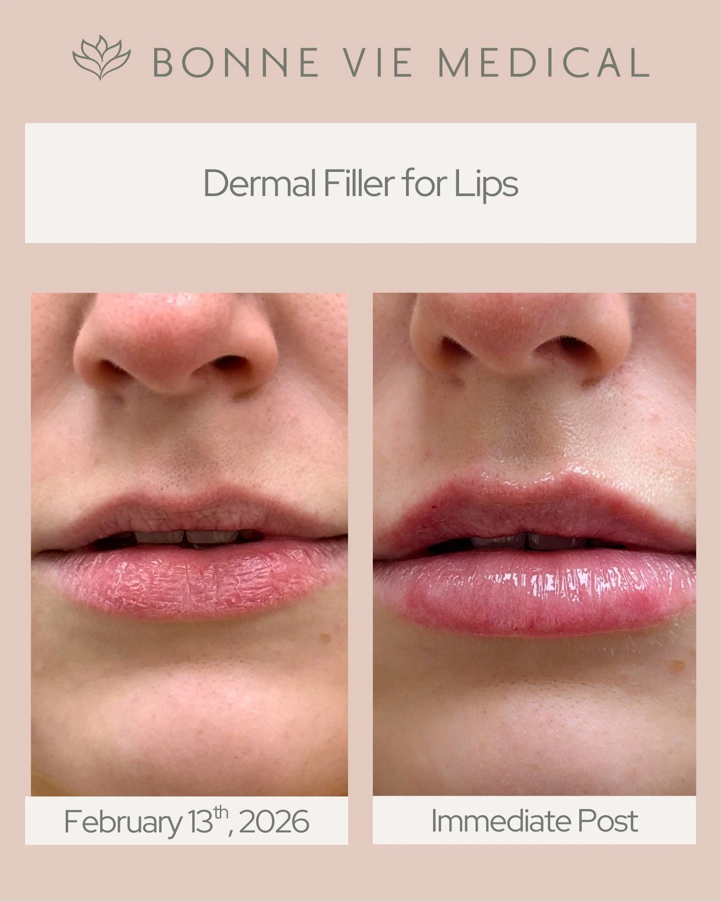 Soft volume. Enhanced shape. Effortless glow. ✨

#LipFiller #DermalFiller #NaturalResults #BonneVieMedical #LipEnhancement #BeforeAndAfter